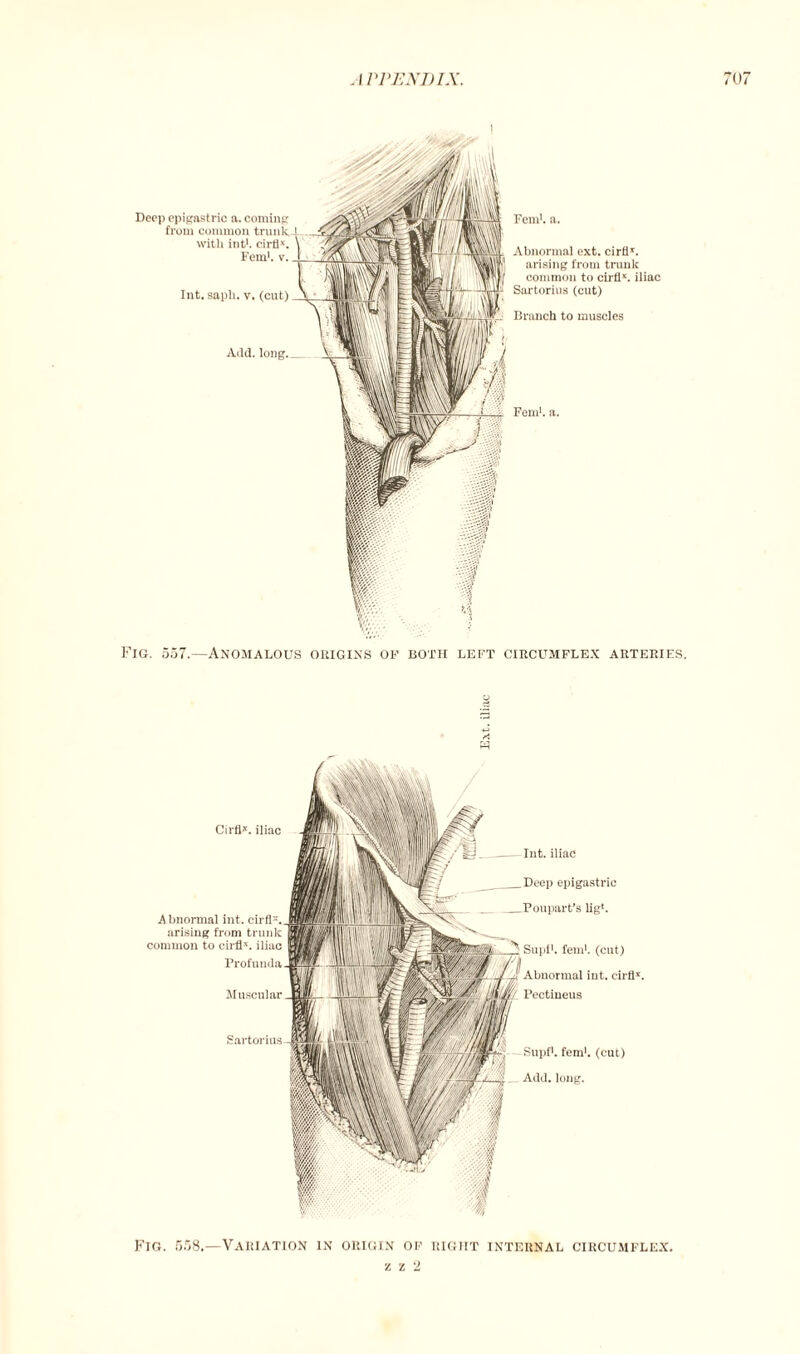Deep epigastric a. coming from common trunk.-] with int1, common trunk-L with int1. cirti*. \ Fern1, v. _I Int. sapli. v. (cut) Add. long. Fern1, a. Abnormal ext. cirfl*. arising from trunk common to cirfl*. iliac Sartorius (cut) Branch to muscles Fern1, a. Fig. 557.—Anomalous origins of both left circumflex arteries. * fd Cirfl*. iliac Abnormal int. arising from trunk common to cirfls. iliac Int. iliac Deep epigastric Poupart’s lig*. Supf1. fern1, (cut) Abnormal int. cirfi*. Pectineus -Supf1. fern1, (cut) . Add. long. Muscular Sartorius Fig. 558.—Variation in origin of right internal circumflex. ■/.L'l