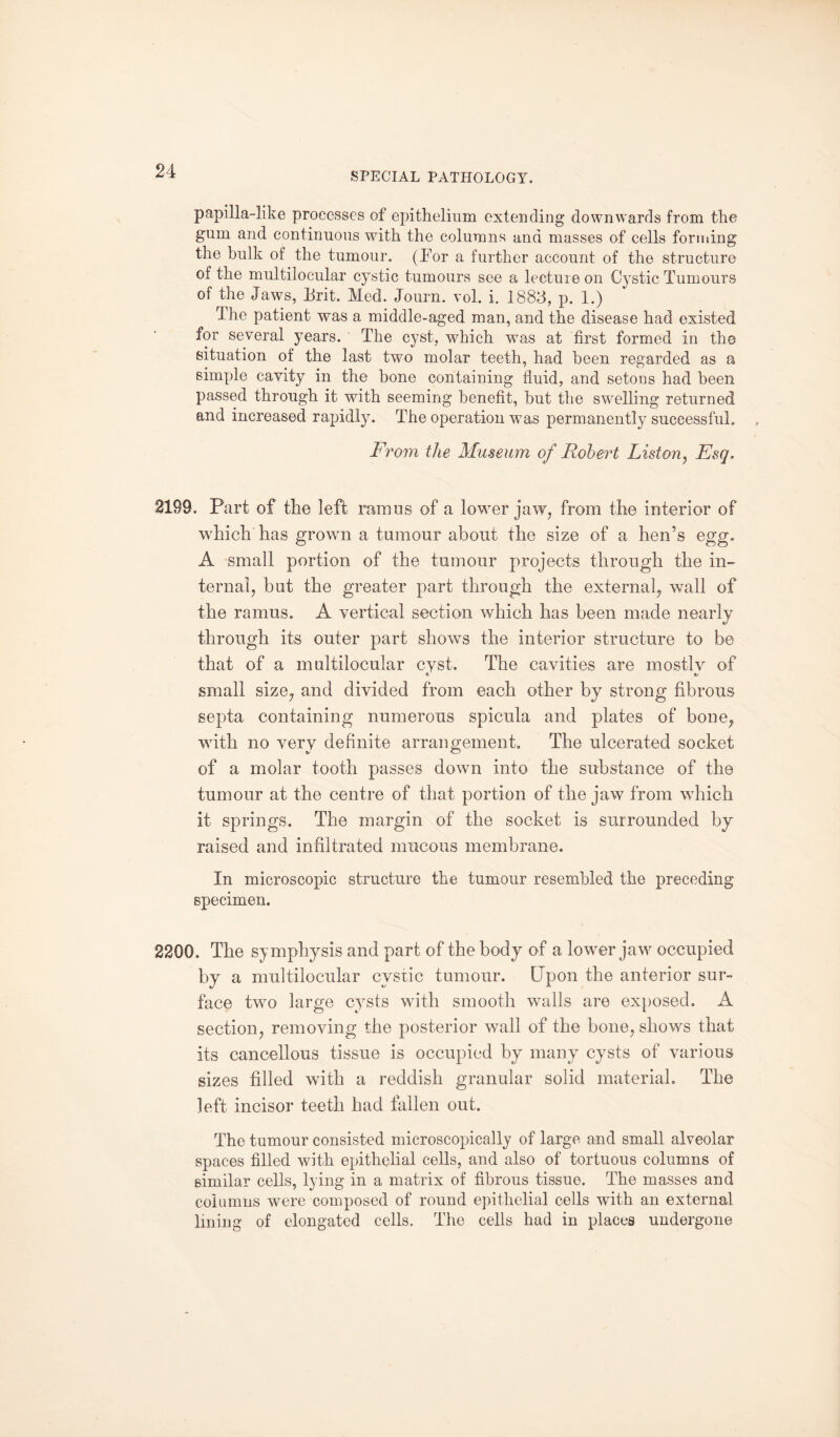 papilla-like processes of epithelium extending downwards from the gum and continuous with the columns ana masses of cells forming the bulk of the tumour. (For a further account of the structure of the multilocular cystic tumours see a lecture on Cystic Tumours of the Jaws, Frit. Med. Journ. vol. i. 1883, p. 1.) The patient was a middle-aged man, and the disease had existed for several years. The cyst, which was at first formed in the situation of the last two molar teeth, had been regarded as a simple cavity in the bone containing fluid, and setons had been passed through it with seeming benefit, but the swelling returned and increased rapidly. The operation was permanently successful. From the Museum of Robert Liston, Esq, 2199. Part of the left ramus of a lower jaw, from the interior of which has grown a tumour about the size of a hen’s egg, A small portion of the tumour projects through the in¬ ternal, hut the greater part through the external, wall of the ramus. A vertical section which has been made nearly through its outer part shows the interior structure to be that of a multilocular cyst. The cavities are mostly of small size, and divided from each other by strong fibrous septa containing numerous spicula and plates of bone, with no very definite arrangement. The ulcerated socket of a molar tooth passes down into the substance of the tumour at the centre of that portion of the jaw from which it springs. The margin of the socket is surrounded by raised and infiltrated mucous membrane. In microscopic structure the tumour resembled the preceding specimen. 2200. The symphysis and part of the body of a lower jaw occupied by a multilocular cystic tumour. Upon the anterior sur¬ face two large cysts with smooth walls are exposed. A section, removing the posterior wall of the bone, shows that its cancellous tissue is occupied by many cysts of various sizes filled with a reddish granular solid material. The left incisor teeth had fallen out. The tumour consisted microscopically of large and small alveolar spaces filled with epithelial cells, and also of tortuous columns of similar cells, lying in a matrix of fibrous tissue. The masses and columns were composed of round epithelial cells with an external lining of elongated cells. The cells had in places undergone