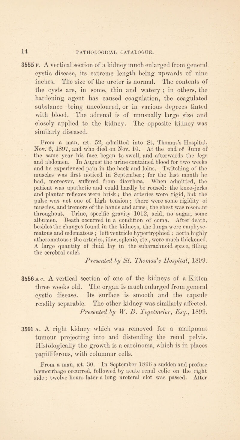 3555 F. A vertical section of a kidney much enlarged from general cystic disease, its extreme length being upwards of nine inches. The size of the ureter is normal. The contents of the cysts are, in some, thin and watery ; in others, the hardening agent has caused coagulation, the coagulated substance being uncoloured, or in various degrees tinted with blood. The adrenal is of unusually large size and closely applied to the kidney. The opposite kidney was similarly diseased. From a man, aet. 52, admitted into St. Thomas’s Hospital, Nov. 6, 1897, and who died on Nov. 10. At the end of June of the same year his face began to swell, and afterwards the legs and abdomen. In August the urine contained blood for two weeks and he experienced pain in the back and loins. Twitching of the muscles was first noticed in September; for the last month he had, moreover, suffered from diarrhoea. When admitted, the patient was apathetic and could hardly be roused: the knee-jerks and plantar reflexes were brisk ; the arteries were rigid, but the pulse was not one of high tension ; there were some rigidity of muscles, and tremors of the hands and arms; the chest was resonant throughout. Urine, specific gravity 1012, acid, no sugar, some albumen. Death occurred in a condition of coma. After death, besides the changes found in the kidneys, the lungs were emphyse¬ matous and oedematous ; left ventricle hypertrophied ; aorta highly atheromatous; the arteries, iliac, splenic, etc., were much thickened. A large quantity of fluid lay in the subarachnoid space, filling the cerebral sulci. Presented by St. Thomas’s Hospital, 1899. 3556 Ac. A vertical section of one of the kidneys of a Kitten three weeks old. The organ is much enlarged from general cystic disease. Its surface is smooth and the capsule readily separable. The other kidney was similarly affected. Presented by ID. B. Tegetmeier, Esq., 1899. 3591 A. A right kidney which was removed for a malignant tumour projecting into and distending the renal pelvis. Histologically the growth is a carcinoma, which is in places papiiliferous, with columnar cells. From a man, set. 30. In September 1896 a sudden and profuse hsemorrhage occurred, followed by acute renal colic on the right side; twelve hours later a long ureteral clot was passed. After