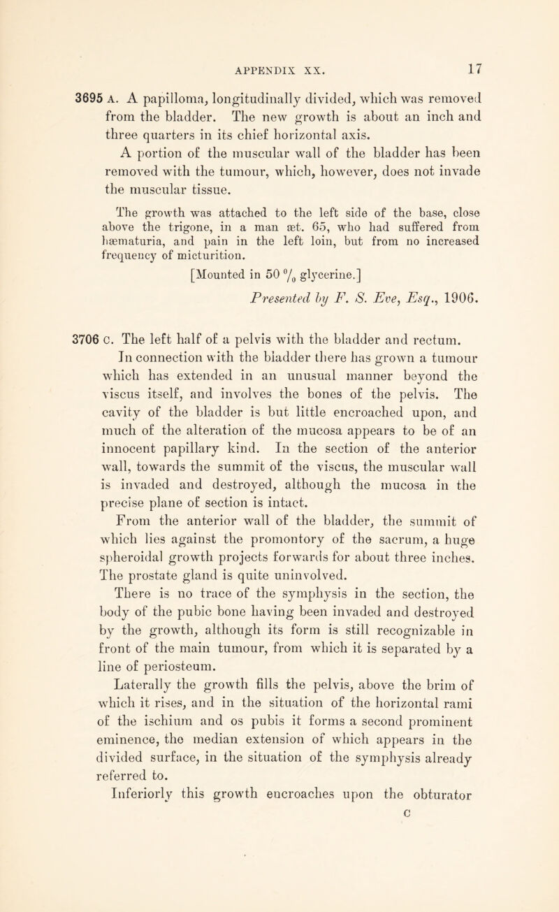 3695 A. A papilloma, longitudinally divided, which was removed from the bladder. The new growth is about an inch and three quarters in its chief horizontal axis. A portion of the muscular wall of the bladder has been removed with the tumour, which, however, does not invade the muscular tissue. The growth was attached to the left side of the base, close above the trigone, in a man set. 65, who had suffered from hsematuria, and pain in the left loin, but from no increased frequency of micturition. [Mounted in 50 °/0 glycerine,] Presented by F. S. Eve, Esq., 1906. 3706 c. The left half of a pelvis with the bladder and rectum. In connection with the bladder there has grown a tumour which has extended in an unusual manner beyond the viscus itself, and involves the bones of the pelvis. The cavity of the bladder is but little encroached upon, and much of the alteration of the mucosa appears to be of an innocent papillary kind. In the section of the anterior wall, towards the summit of the viscus, the muscular wall is invaded and destroyed, although the mucosa in the precise plane of section is intact. From the anterior wall of the bladder, the summit of which lies against the promontory of the sacrum, a huge spheroidal growth projects forwards for about three inches. The prostate gland is quite uninvolved. There is no trace of the symphysis in the section, the body of the pubic bone having been invaded and destroyed by the growth, although its form is still recognizable in front of the main tumour, from which it is separated by a line of periosteum. Laterally the growth fills the pelvis, above the brim of which it rises, and in the situation of the horizontal rami of the ischium and os pubis it forms a second prominent eminence, the median extension of which appears in the divided surface, in the situation of the symphysis already referred to. Interiorly this growth encroaches upon the obturator c
