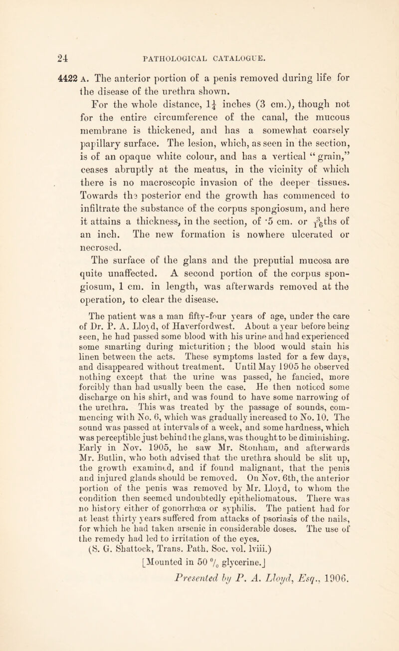 4422 A. The anterior portion of a penis removed during life for the disease of the urethra shown. For the whole distance, 1^ inches (3 cm.), though not for the entire circumference of the canal, the mucous membrane is thickened, and has a somewhat coarsely papillary surface. The lesion, which, as seen in the section, is of an opaque white colour, and has a vertical “ grain,” ceases abruptly at the meatus, in the vicinity of which there is no macroscopic invasion of the deeper tissues. Towards the posterior end the growth has commenced to infiltrate the substance of the corpus spongiosum, and here it attains a thickness, in the section, of '5 cm. or pgths of an inch. The new formation is nowhere ulcerated or necrosed. The surface of the glans and the preputial mucosa are quite unaffected. A second portion of the corpus spon¬ giosum, 1 cm. in length, was afterwards removed at the operation, to clear the disease. The patient was a man fifty-four years of age, under the care of Dr. P. A. Llo)d, of Haverfordwest. About a year before being: seen, he had passed some blood with his urine and had experienced some smarting during micturition ; the blood would stain his linen between the acts. These symptoms lasted for a few days, and disappeared without treatment. Until May 1905 he observed nothing except that the urine was passed, he fancied, more forcibly than had usually been the case. He then noticed some discharge on his shirt, and was found to have some narrowing of the urethra. This was treated by the passage of sounds, com¬ mencing with No. 6, which was gradually increased to No. 10. The sound was passed at intervals of a week, and some hardness, which was perceptible just behind the glans, was thought to be diminishing. Early in Nov. 1905, he saw Mr. Stonham, and afterwards Mr. Butlin, who both advised that the urethra should be slit up, the growth examintd, and if found malignant, that the penis and injured glands should be removed. On Nov. 6th, the anterior portion of the penis was removed by Mr. Lloyd, to whom the condition then seemed undoubtedly epitheliomatous. There was no history either of gonorrhoea or syphilis. The patient had for at least thirty years suffered from attacks of psoriasis of the nails, for which he had taken arsenic in considerable doses. The use of the remedy had led to irritation of the eyes. (8. G. 8hattock, Trans. Path. Soc. vol. lviii.) [Mounted in 50 °/0 glycerine.]