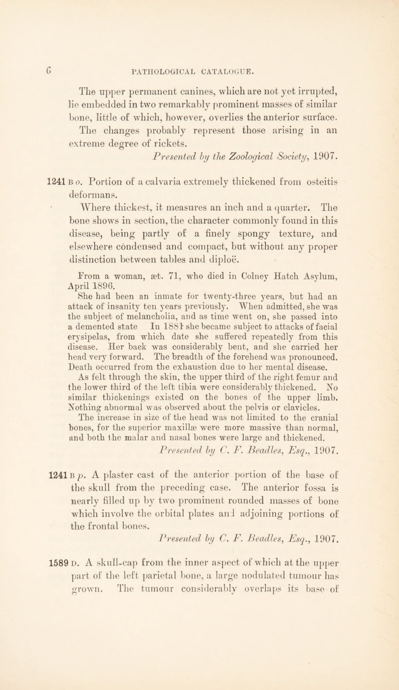 The upper permanent canines, which are not yet irrupted, lie embedded in two remarkably prominent masses o£ similar bone, little o£ which, however, overlies the anterior surface. The changes probably represent those arising in an extreme degree of rickets. Presented by the Zoological Society, 1907. 1241 B o. Portion of a calvaria extremely thickened from osteitis deformans. Where thickest, it measures an inch and a quarter. The bone shows in section, the character commonly found in this disease, being partly of a finely spongy texture, and elsewhere condensed and compact, but without any proper distinction between tables and diploe. Prom a woman, set. 71, who died in Colney Hatch Asylum, April 1896. She had been an inmate for twenty-three years, but had an attack of insanity ten years previously. When admitted, she was the subject of melancholia, and as time went on, she passed into a demented state In 1881 she became subject to attacks of facial erysipelas, from which date she suffered repeatedly from this disease. Her back was considerably bent, and she carried her head very forward. The breadth of the forehead was pronounced. Death occurred from the exhaustion due to her mental disease. As felt through the skin, the upper third of the right femur and the lower third of the left tibia were considerably thickened. Ho similar thickenings existed on the bones of the upper limb. Nothing abnormal was observed about the pelvis or clavicles. The increase in size of the head was not limited to the cranial bones, for the superior maxillae were more massive than normal, and both the malar and nasal bones were large and thickened. Presented by C. F. Beadles, Esq., 1907. 1241B p. A plaster cast of the anterior portion of the base of the skull from the preceding case. The anterior fossa is nearly filled up by two prominent rounded masses of bone which involve the orbital plates and adjoining portions of the frontal bones. Presented by C. F. Beadles, Esq., 1907, 1589 D. A skull-cap from the inner aspect of which at the upper part of the left parietal bone, a large nodulated tumour has grown. The tumour considerably overlaps its base of