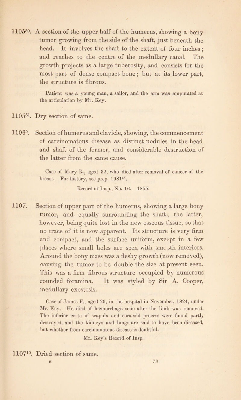 11Q550. A section of the upper half of the humerus, showing a bony tumor growing from the side of the shaft, just beneath the head. It involves the shaft to the extent of four inches; and reaches to the centre of the medullary canal. The growth projects as a large tuberosity, and consists for the most part of dense compact bone; but at its lower part, the structure is fibrous. Patient was a young man, a sailor, and the arm was amputated at the articulation by Mr. Key. 110551. Dry section of same. 11065. Section of humerus and clavicle, showing, the commencement of carcinomatous disease as distinct nodules in the head and shaft of the former, and considerable destruction of the latter from the same cause. Case of Mary R., aged 32, who died after removal of cancer of the breast. For history, see prep. 108145. Record of Insp., No. 16. 1855. 1107. Section of upper part of the humerus, showing a large bony tumor, and equally surrounding the shaft; the latter, however, being quite lost in the new osseous tissue, so that no trace of it is now apparent. Its structure is very firm and compact, and the surface uniform, except in a few places where small holes are seen with smooth interiors. Around the bony mass was a fleshy growth (now removed), causing the tumor to be double the size at present seen. This was a firm fibrous structure occupied by numerous rounded foramina. It was styled by Sir A. Cooper, medullary exostosis. Case of James F., aged 23, in the hospital in November, 1824, under Mr. Key. He died of hsemorrhage soon after the limb was removed. The inferior costa of scapula and coracoid process were found partly destroyed, and the kidneys and lungs are said to have been diseased, but whether from carcinomatous disease is doubtful. Mr. Key’s Record of Insp. 110710. Dried section of same.