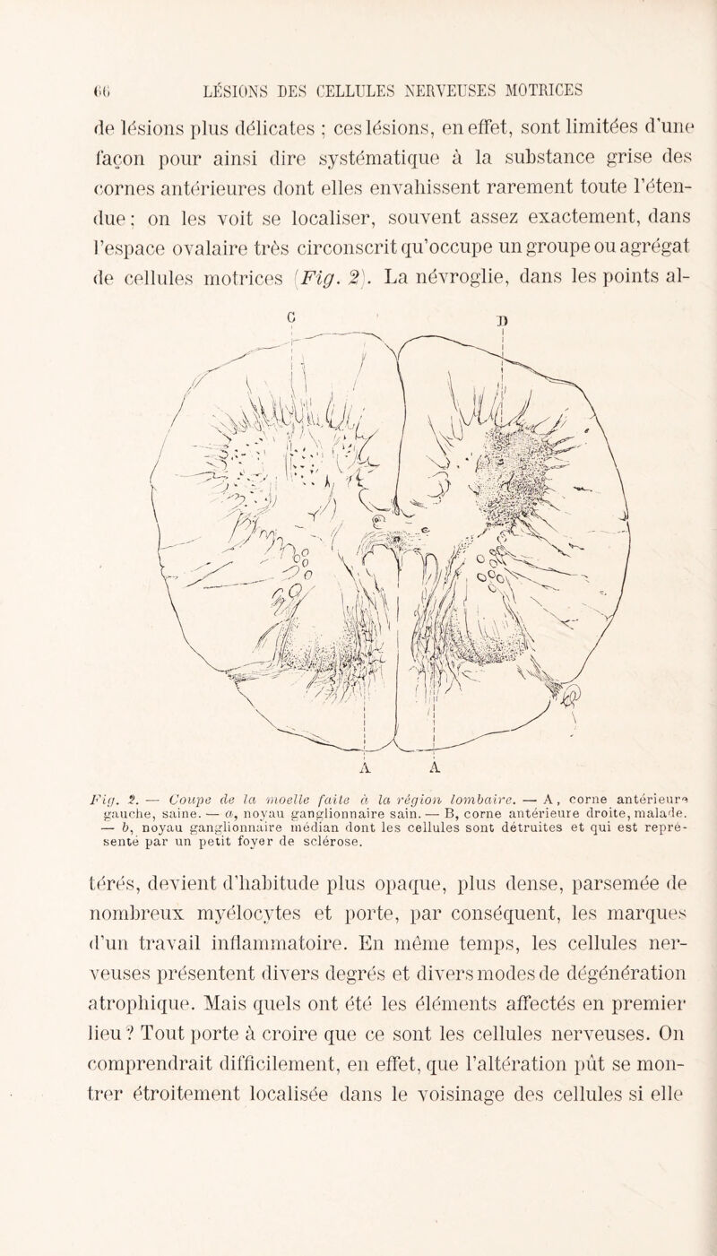 de lésions plus délicates ; ces lésions, en effet, sont limitées d’une façon pour ainsi dire systématique à la substance grise des cornes antérieures dont elles envahissent rarement toute l’éten¬ due ; on les voit se localiser, souvent assez exactement, dans l’espace ovalaire très circonscrit qu’occupe un groupe ou agrégat de cellules motrices [Fig. 2). La névroglie, dans les points al- Fig. i*. — Coupe de la moelle faite à la région lombaire. — A, corne antérieure gauche, saine.— a, noyau ganglionnaire sain. — B, corne antérieure droite, malade. — 6, noyau ganglionnaire médian dont les cellules sont détruites et qui est repré¬ senté par un petit foyer de sclérose. térés, devient d’habitude plus opaque, plus dense, parsemée de nombreux myélocytes et porte, par conséquent, les marques d’un travail inflammatoire. En même temps, les cellules ner¬ veuses présentent divers degrés et divers modes de dégénération atrophique. Mais quels ont été les éléments affectés en premier lieu ? Tout porte à croire que ce sont les cellules nerveuses. On comprendrait difficilement, en effet, que l’altération pût se mon¬ trer étroitement localisée dans le voisinage des cellules si elle