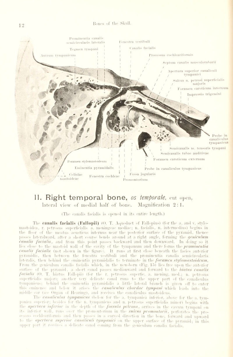 1 2 Prominentia canal is scmicircularis lateralis I-rncstra vestibuli Processus eoehleariformis r Septum canalis limsciilotiibarii / / Apertura superior eanalieuli / / tympanici / / Sulcus n. petrosi superficialis / / / majoris / / / Foramen careticum internum 1 Impressio trigemini Probe in canaliculus I tympanicus | Semicanalis m. tensoris tympani Semicanalis tubae audit ivae i Foramen caroticum externum I Probe in canaliculus tympanicus | Fossa jugularis Promontorium # * z t ympani 1 Tegmen Antrum tympanicum i 11. Right temporal bone, os iemporale, cut open, lateral view of medial half of bone. Magnification 2:1. (Tho canalis facialis is opened in its entire length.) The canalis facialis (Fallopii) (<». T. Aqueduct of Fallopius) (for the a. and v. stylo- mastoidea, r. petrosas supcrlicialis a. meningcae mediae; n. facialis, n. intennedius) begins in the floor of the meatus aeustieus internus near the posterior surface of the pyramid, thence passes lateralwaril, after a short course heads around at a right angle, forming the geniculum canalis facialis, and from this point passes backward and then downward. In doing so it lies elose to the mastoid wall of tlie emits of the tympanum and there forms the prominentia canalis facialis (not shown in the figure). It runs at first close beneath the facies anterior pyrnmidis. then between the fenestra vestilmli and the prominentia canalis scmicircularis lateralis, then behind the eminentia pyramidalis to terminate in the foramen sUjlomastoiilcum. From the geniculum canalis facialis which, in the new-born (Fig. 15) lies free upon the anterior surface of the pyramid, a short canal passes medianward and forward to the hiatus canalis facialis (0. T. hiatus Fallopii) (for tin* r. petrosus supertic. a. moiling, mod.; n. petrosus sujierficialis major); another very delicate canal runs to the upper part of the canaliculus tympanicus; behind the eminentia pyramidalis a little lateral branch is given off to enter this eminence and below it arise.- the canaliculus chordae tympani which leads into the middle ear (see Organ of Hearing), and receives the canaliculus mastoidcus. The canaliculus tympanicus (below for the a. tympaniea inferior, above for the a. tvm- paniea superior: beside- Ibr the n. tympanieus and n. petrosus superficialis minor) heirins with the apertura inferior in the depth of the fossula petrosa, arrives in the cavum tvmpani on il- inferior wall, runs over the promontorium in the sulcus promontorii. perforates the pro- ee.-sus cocldearilbrniis and then passes in a curved direction in the hone, forward and upward to the apertura superior eanalieuli tympanici on the upper surfat.. the pyramid; in this upper purl it receives a delicate canal coming from the geniculum canalis facialis.