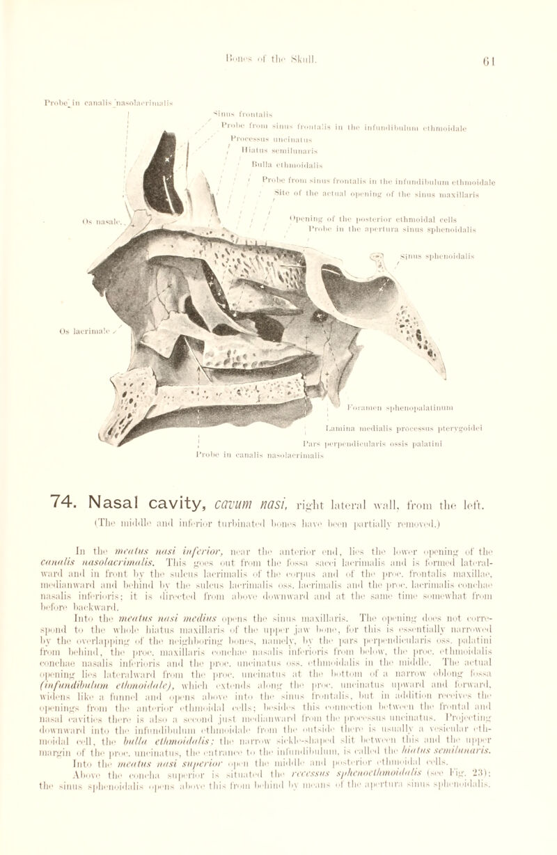 Probe’ in eanalis nasolacrimalis ^inus frontalis Probe from sinus frontalis in the infundibulum ethmoidale Processus uncinatus / Hiatus semilunaris Bulla ethmoidal is 1 Probe from sinus frontalis in the infundibulum ethmoidale Site of the actual opening of the sinus maxillaris f Opening of the posterior ethmoidal cells Probe in the apertura sinus sphenoidalis sinus sphenoidalis Os lacrimal* 'V Foramen sphenopalatinum Lamina medialis processus pterygoidei Pars perpcndieularis ossis palatini Probe in eanalis nasolacrimalis 74. NclScll cavity, CQVIWI FIQSl, right lateral Avail, from the left. (The middle and inferior turbinated hones have been partially removed.) In the meatus nasi inferior, near the anterior end, lies the hover opening of the eanalis nasolacrimalis. This goes out from the fossa sacei laerimalis and is formed lateral- ward and in front by the sulcus laerimalis of the corpus and of the proc. frontalis maxillae, lnedianward and behind by the sulcus laerimalis oss. laerimalis and the proc. laerimalis eonehae nasalis inferioris; it is directed from above downward and at the same time somewhat from before backward. Into the meatus nasi meclius opens the sinus maxillaris. The opening does not corre¬ spond to the whole hiatus maxillaris of the upper jaw hone, for this is essentially narrowed by the overlapping of the neighboring bones, namely, by the pars perpcndieularis oss. palatini from behind, the proc. maxillaris eonehae nasalis inferioris from below, the proc. ethmoidalis eonehae nasalis inferioris and the proc. uncinatus oss. ethmoidalis in the middle. 1 lie actual opening lies lateralward from the proc. uncinatus at the bottom of a narrow oblong fos,-;i (infundibulum ethmoidale), which extends along the proc. uncinatus upward and forward, widens like a funnel and opens above into the sinus frontalis, but in addition receives the openings from the anterior othmoidal cells; besides this connection between the frontal and nasal cavities there is also a second just medianward from the processus uncinatus. Projecting downward into the infundibulum ethmoidale from the outside there is usualh a vesicular eth¬ moidal cell, the bulla ethmoidalis; the narrow sickle-shaped slit between this and the upper margin of the proc. uncinatus, the entrance to the infundibulum, is called the hiatus semilunaris. Into the meatus aasi superior open the middle and posterior ethmoidal cells. Above the concha superior is situated the reeessus sjihenoethmoidalis (see Fig. 23); the sinus sphenoidalis opens above tliis from behind by means of the apertura sinus sphenoidalis.