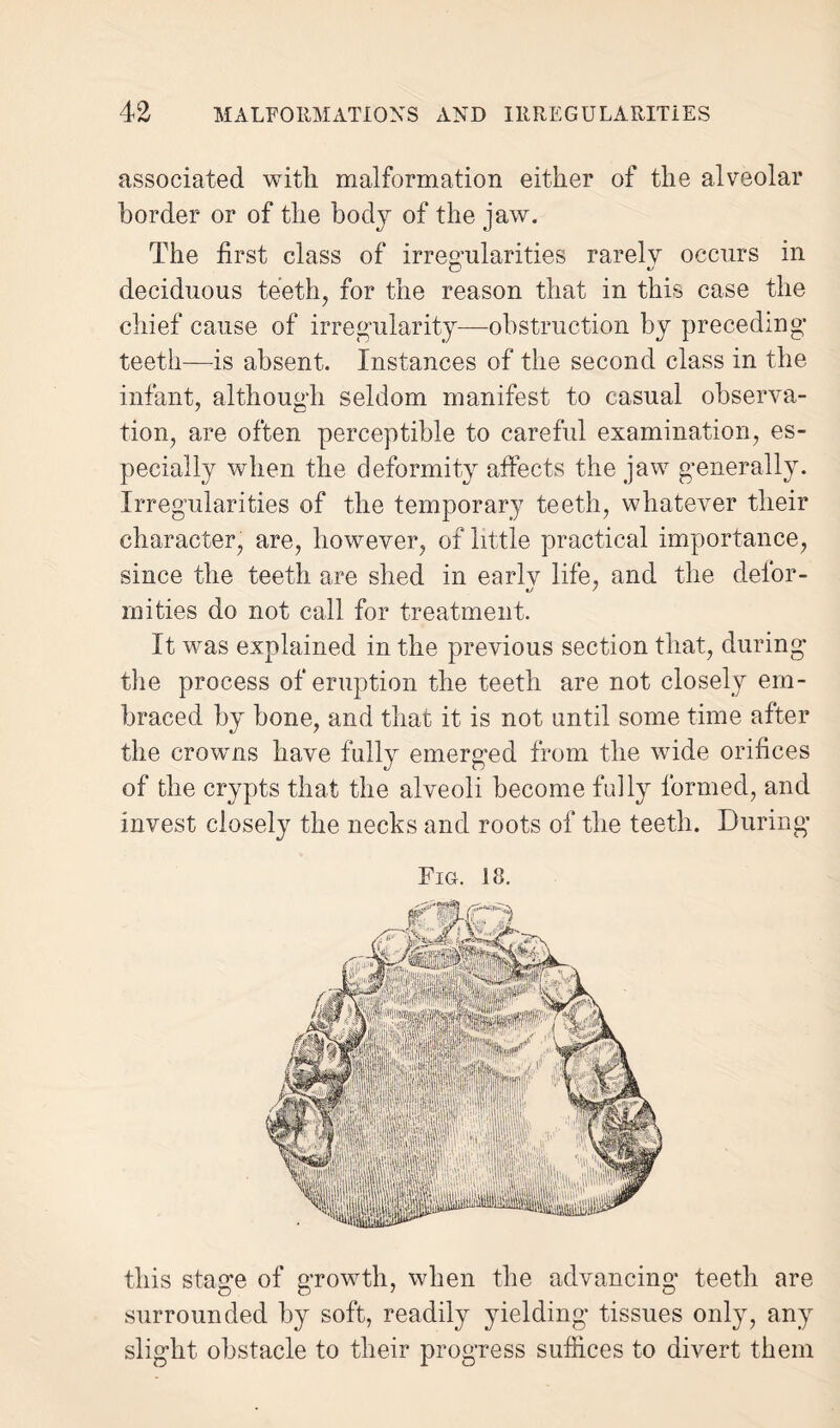 associated with malformation either of the alveolar border or of the body of the jaw. The first class of irregularities rarely occurs in deciduous teeth, for the reason that in this case the chief cause of irregularity—-obstruction by preceding teeth—is absent. Instances of the second class in the infant, although seldom manifest to casual observa¬ tion, are often perceptible to careful examination, es¬ pecially when the deformity affects the jaw generally. Irregularities of the temporary teeth, whatever their character, are, however, of little practical importance, since the teeth are shed in early life, and the defor- •j ' mi ties do not call for treatment. It was explained in the previous section that, during the process of eruption the teeth are not closely em¬ braced by bone, and that it is not until some time after the crowns have fully emerged from the wide orifices of the crypts that the alveoli become fully formed, and invest closely the necks and roots of the teeth. During Fig. 18. this stage of growth, when the advancing teeth are surrounded by soft, readily yielding tissues only, any slight obstacle to their progress suffices to divert them