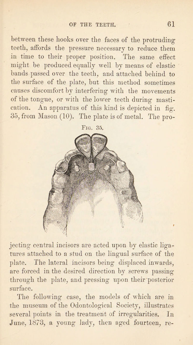 between these hooks over the faces of the protruding' teeth, affords the pressure necessary to reduce them in time to their proper position. The same effect might be produced equally well by means of elastic bands passed over the teeth, and attached behind to the surface of the plate, but this method sometimes causes discomfort by interfering with the movements of the tongue, or with the lower teeth during’ masti¬ cation. An apparatus of this kind is depicted in fig. 35, from Mason (10). The plate is of metal. The pro- Fig. 35. jecting central incisors are acted upon by elastic liga¬ tures attached to a stud on the lingual surface of the plate. The lateral incisors being displaced inwards, are forced in the desired direction by screws passing through the plate, and pressing upon their posterior surface. The following case, the models of which are in the museum of the Odontological Society, illustrates several points in the treatment of irregularities. In June, 1873, a young lady, then aged fourteen, re-