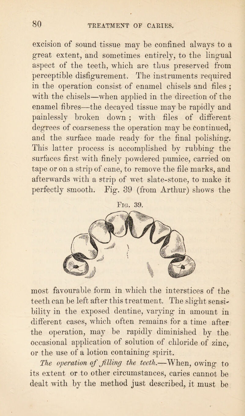 excision of sound tissue may be confined always to a great extent, and sometimes entirely, to the lingual aspect of the teeth, which are thus preserved from perceptible disfigurement. The instruments required in the operation consist of enamel chisels and files j with the chisels—when applied in the direction of the enamel fibres—the decayed tissue may be rapidly and painlessly broken down ; with files of different degrees of coarseness the operation may be continued, and the surface made ready for the final polishing. This latter process is accomplished by rubbing the surfaces first with finely powdered pumice, carried on tape or on a strip of cane, to remove the file marks, and afterwards with a strip of wTet slate-stone, to make it perfectly smooth. Fig. 89 (from Arthur) shows the most favourable form in which the interstices of the teeth can be left after this treatment The slight sensi¬ bility in the exposed dentine, varying in amount in different cases, which often remains for a time after the operation, may be rapidly diminished by the occasional application of solution of chloride of zinc, or the use of a lotion containing spirit. The operation of filling the teeth.—When, owing to its extent or to other circumstances, caries cannot be dealt with by the method just described, it must be