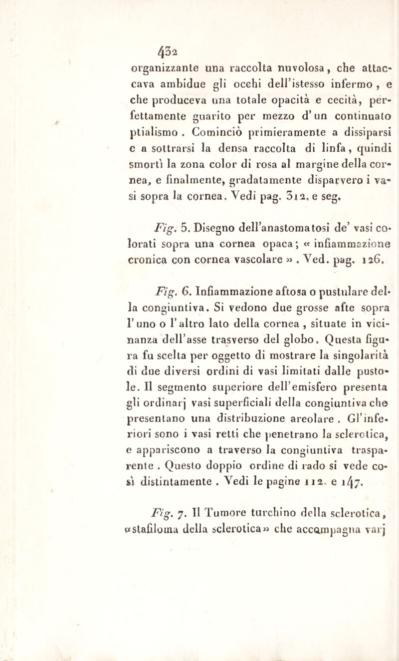 4 3*2 organizzante una raccolta nuvolosa, che attac¬ cava ambidue gli occhi dell’istesso infermo , e che produceva una totale opacità e cecità, per¬ fettamente guarito per mezzo d’un continuato ptialismo . Cominciò primieramente a dissiparsi c a sottrarsi la densa raccolta di linfa, quindi smorti la zona color di rosa al margine della cor¬ nea, e finalmente, gradatamente disparvero i va¬ si sopra la cornea. Vedi pag. 3i2, e seg, Fig. 5. Disegno delfanastomatosi de’ vasi co¬ lorati sopra una cornea opaca; « infiammazione cronica con cornea vascolare » . Ved. pag. 126, Fig. 6. Infiammazione aftosa o pustulare del¬ la congiuntiva. Si vedono due grosse afte sopra I’ uno o l’altro lato della cornea , situate in vici¬ nanza dell’asse trasverso del globo. Questa figu¬ ra fu scelta per oggetto di mostrare la singolarità di due diversi ordini di vasi limitati dalle pusto¬ le. Il segmento superiore dell’emisfero presenta gli ordinarj vasi superficiali della congiuntiva che presentano una distribuzione areolare . Gl’infe¬ riori sono i vasi retti che penetrano la sclerotica, e appariscono a traverso la congiuntiva traspa¬ rente . Questo doppio ordine di rado si vede co¬ si distintamente . Vedi le pagine 112. e 147* Fig. 7. II T umore turchino della sclerotica, ^slafiloina della sclerotica « che accompagna varj