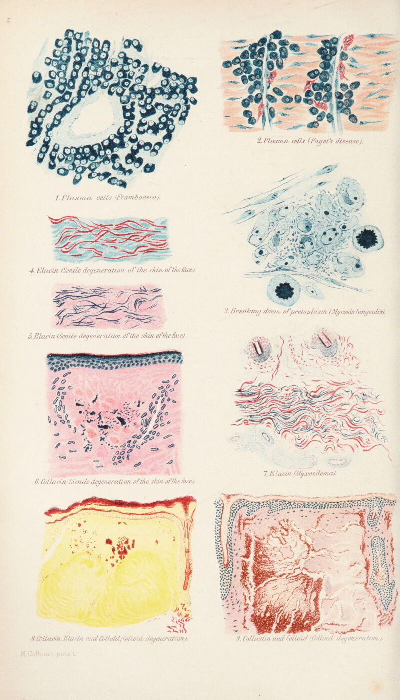 l.PlcLsrrut cells- (Frcimboesia/. 4. Elacin (Senile degeneration of the skin of the face). r5. Elacin (Senile degeneration of the skin of the face). **«**AjSei sSf $«<*#** cF # o & £y o e® it - J F; '!■ % *‘W 9 & <s& @ „X* e‘i>. o 6> Iff <&& \y-' - r. ^ — <S> JS O&f O **_« „ _ ® ^ - /^<5' C3 <5^ Ä Collet ein (Senile dccjeneralion of the skin of the thee). 2. Plasma cells (Panel's disease). • >■ Breakiruj down, o(protoplasm (Mycosis funyoides). 7 Elacuv (Myjcopilemo/J.