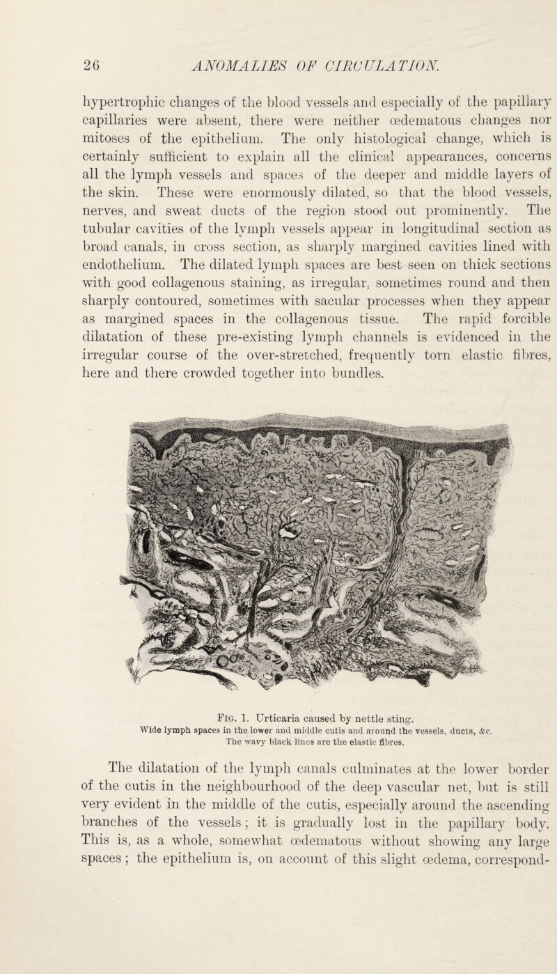 hypertrophic changes of the blood vessels and especially of the papillary capillaries were absent, there were neither oedematous changes nor mitoses of the epithelium. The only histological change, which is certainly sufficient to explain all the clinical appearances, concerns all the lymph vessels and spaces of the deeper and middle layers of the skin. These were enormously dilated, so that the blood vessels, nerves, and sweat ducts of the region stood out prominently. The tubular cavities of the lymph vessels appear in longitudinal section as broad canals, in cross section, as sharply margined cavities lined with endothelium. The dilated lymph spaces are best seen on thick sections with good collagenous staining, as irregular, sometimes round and then sharply contoured, sometimes with sacular processes when they appear as margined spaces in the collagenous tissue. The rapid forcible dilatation of these pre-existing lymph channels is evidenced in the irregular course of the over-stretched, frequently torn elastic fibres, here and there crowded together into bundles. Fig. 1. Urticaria caused by nettle sting. Wide lymph spaces in the lower and middle cutis and around the vessels, ducts, &c. The wavy black lines are the elastic fibres. The dilatation of the lymph canals culminates at the lower border of the cutis in the neighbourhood of the deep vascular net, but is still very evident in the middle of the cutis, especially around the ascending branches of the vessels; it is gradually lost in the papillary body. This is, as a whole, somewhat oedematous without showing any large spaces; the epithelium is, on account of this slight oedema, correspond-