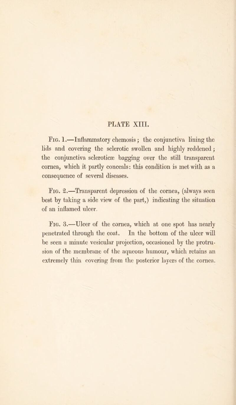Eig. I.—Inflammatory cliemosis; the conjunctiva lining the lids and covering the sclerotic swollen and highly reddened; the conjunctiva scleroticse bagging over the still transparent cornea^ which it partly conceals: this condition is met with as a consequence of several diseases. Eig. 2.—Transparent depression of the cornea, (always seen best by taking a side view of the part,) indicating the situation of an inflamed ulcer. Eig. 3.—Ulcer of the cornea, which at one spot has nearly penetrated through the coat. In the bottom of the ulcer will be seen a minute vesicular projection, occasioned by the protru¬ sion of the membrane of the aqueous humour, which retains an extremely thin covering from the posterior layers of the cornea.