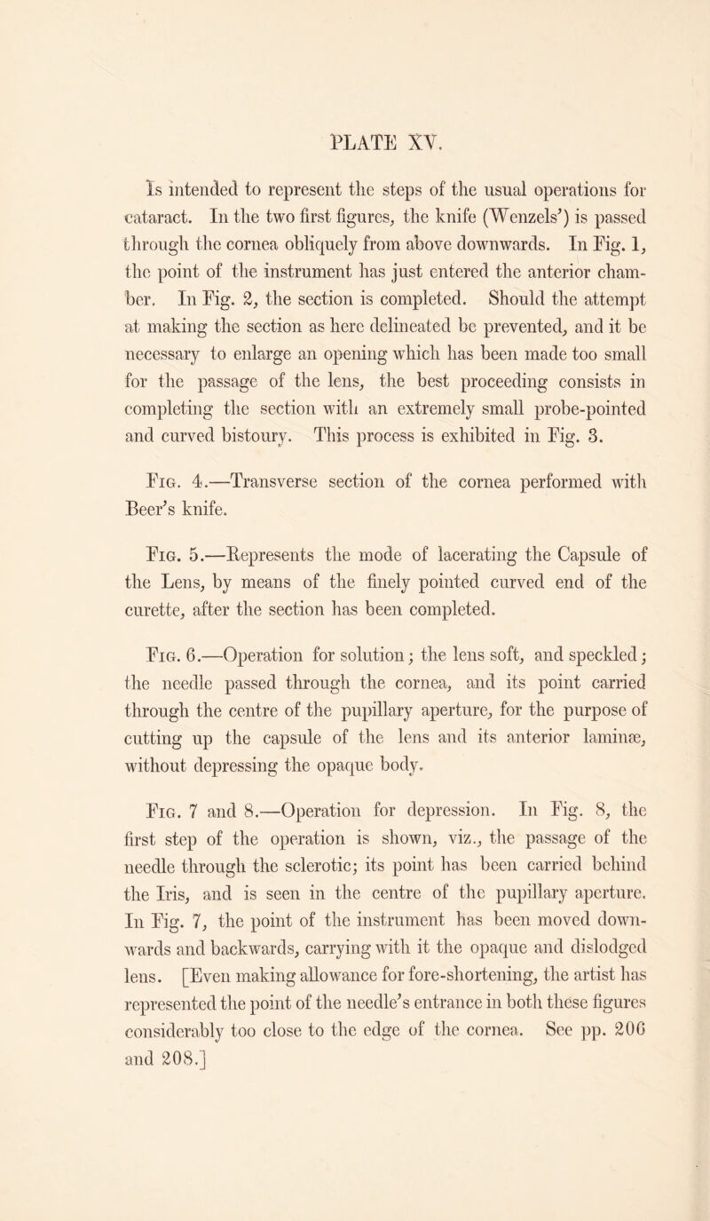 Is intended to represent the steps of the usual operations for cataract. In the two first figures^ the knife (Wenzels^) is passed through the cornea obliquely from above downwards. In Eig. the point of the instrument has just entered the anterior cham¬ ber. In Eig. 2, the section is completed. Should the attempt at making the section as here delineated be prevented^ and it be necessary to enlarge an opening which has been made too small for the passage of the lens^, the best proceeding consists in completing the section with an extremely small probe-pointed and curved bistoury. This process is exhibited in Eig. 3. Eig. 4.—Transverse section of the cornea performed with BeeEs knife. Eig. 5.—Eepresents the mode of lacerating the Capsule of the Lens, by means of the finely pointed curved end of the curette, after the section has been completed. Eig. 6.—Operation for solution; the lens soft, and speckled; the needle passed through the cornea, and its point carried through the centre of the pupillary aperture, for the purpose of cutting up the capsule of the lens and its anterior laminse, without depressing the opaque body. Eig. 7 and 8.—Operation for depression. In Eig. 8, the first step of the operation is shown, viz., the passage of the needle through the sclerotic; its point has been carried behind the Iris, and is seen in the eentre of the pupillary aperture. In Eig. 7, the point of the instrument has been moved down¬ wards and backwards, carrying with it the opaque and dislodged lens. [Even making allowance for fore-shortening, the artist has represented the point of the needless entrance in both these figures considerably too close to the edge of the cornea. See pp. 20G and 208.]