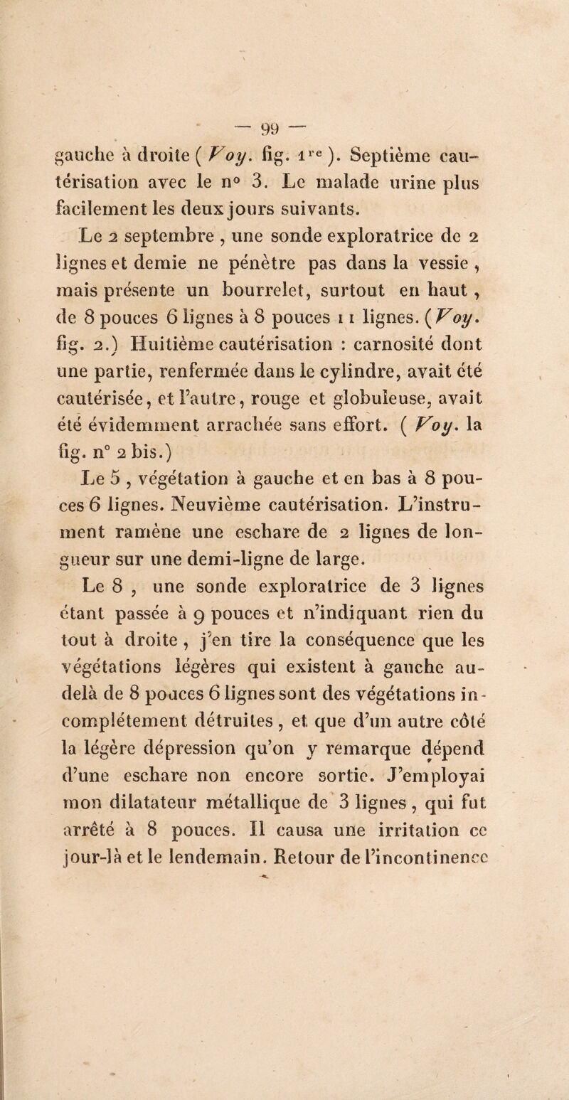 » gauche à droite ( V oy. fig. ire ). Septième eau- térisation avec le n° 3. Le malade urine plus facilement les deux jours suivants. Le 2 septembre , une sonde exploratrice de 2 lignes et demie ne pénètre pas dans la vessie , mais présente un bourrelet, surtout en haut , de 8 pouces 6 lignes à 8 pouces 11 lignes. ( Voy. fîg. 2.) Huitième cautérisation : carnosité dont *3 y une partie, renfermée dans le cylindre, avait été cautérisée, et l’autre, rouge et globuleuse, avait été évidemment arrachée sans effort. ( Voy, la fig. n° 2 bis.) Le 5 , végétation à gauche et en bas à 8 pou¬ ces 6 lignes. Neuvième cautérisation. L’instru¬ ment ramène une eschare de 2 lignes de lon¬ gueur sur une demi-ligne de large. Le 8 , une sonde exploratrice de 3 lignes étant passée à 9 pouces et n’indiquant rien du tout à droite , j’en tire la conséquence que les végétations légères qui existent à gauche au- delà de 8 pouces 6 lignes sont des végétations in ¬ complètement détruites, et que d’un autre côté la légère dépression qu’on y remarque dépend d’une eschare non encore sortie. J’employai mon dilatateur métallique de 3 lignes, qui fut arrêté à 8 pouces. Il causa une irritation ce jour-là et le lendemain. Retour de l’incontinence