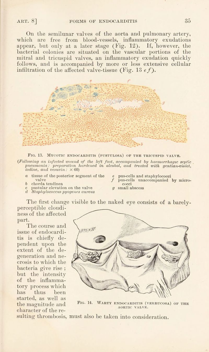 On the semilunar valves of the aorta and pulmonary artery, which are free from blood-vessels, inflammatory exudations appear, but only at a later stage (Fig. 12). If, however, the bacterial colonies are situated on the vascular portions of the mitral and tricuspid valves, an inflammatory exudation quickly follows, and is accompanied by more or less extensive cellular infiltration of the affected valve-tissue (Fig. 13 <?/). Fig. 13. Mycotic endocarditis (pustulosa) of the tricuspid yalye. (Following an infected wound of the left foot, accompanied by haemorrhagic septic pneumonia: preparation hardened in alcohol, and treated with gentian-violet, iodine, and vesuvin: x 60) a tissue of the posterior segment of the valve b chorda tendinea c pustular elevation on the valve d Staphylococcus pyogenes aureus e pus-cells and staphylococci / pus-cells unaccompanied by micro¬ cocci g small abscess The first change visible to the naked eye consists of a barely- perceptible cloudi¬ ness of the affected part. The course and issue of endocardi¬ tis is chiefly de¬ pendent upon the extent of the de¬ generation and ne¬ crosis to which the bacteria give rise ; but the intensity of the inflamma¬ tory process which has thus been started, as well as Fig. 14. Warty endocarditis (verrucosa) of the , AORTIC VALVE. character ot the re¬ sulting thrombosis, must also be taken into consideration. the magnitude and