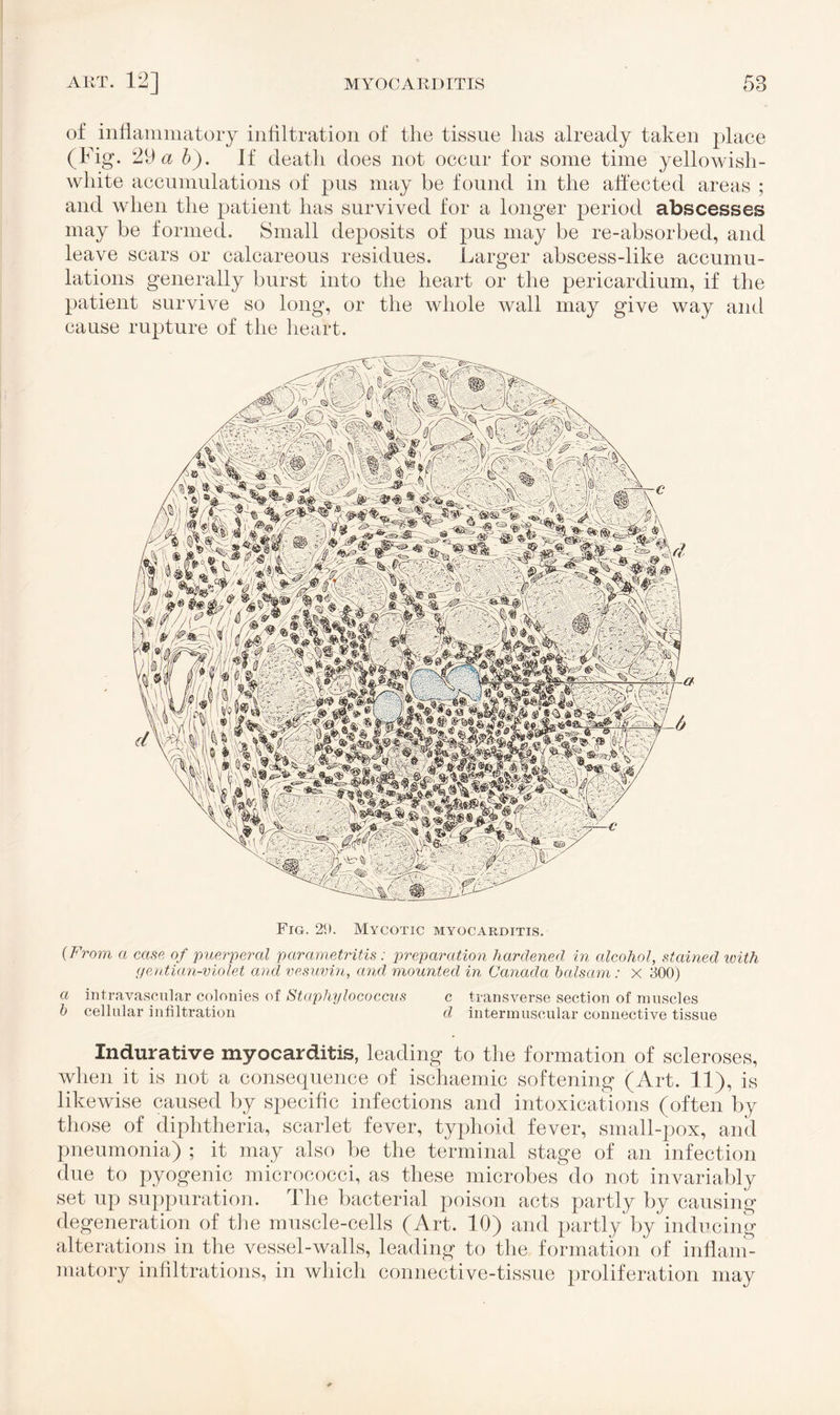 of inflammatory infiltration of the tissue lias already taken place (Fig. 29 a b). Jf death does not occur for some time yellowish- white accumulations of pus may be found in the affected areas ; and when the patient has survived for a longer period abscesses may be formed. Small deposits of pus may be re-absorbed, and leave scars or calcareous residues. Larger abscess-like accumu¬ lations generally burst into the heart or the pericardium, if the patient survive so long, or the whole wall may give way and cause rupture of the heart. Fig. 29. Mycotic myocarditis. {From a case of puerperal parametritis : preparation hardened in alcohol, stained with gentian-violet and vesuvin, and mounted in Canada balsam: X 300) a intravascular colonies of Staphylococcus c transverse section of muscles b cellular infiltration cl intermuscular connective tissue Indurative myocarditis, leading to the formation of scleroses, when it is not a consequence of ischaemic softening (Art. 11), is likewise caused by specific infections and intoxications (often by those of diphtheria, scarlet fever, typhoid fever, small-pox, and pneumonia) ; it may also be the terminal stage of an infection due to pyogenic micrococci, as these microbes do not invariably set up suppuration. The bacterial poison acts partly by causing degeneration of the muscle-cells (Art. 10) and partly by inducing alterations in the vessel-walls, leading to the formation of inflam¬ matory infiltrations, in which connective-tissue proliferation may