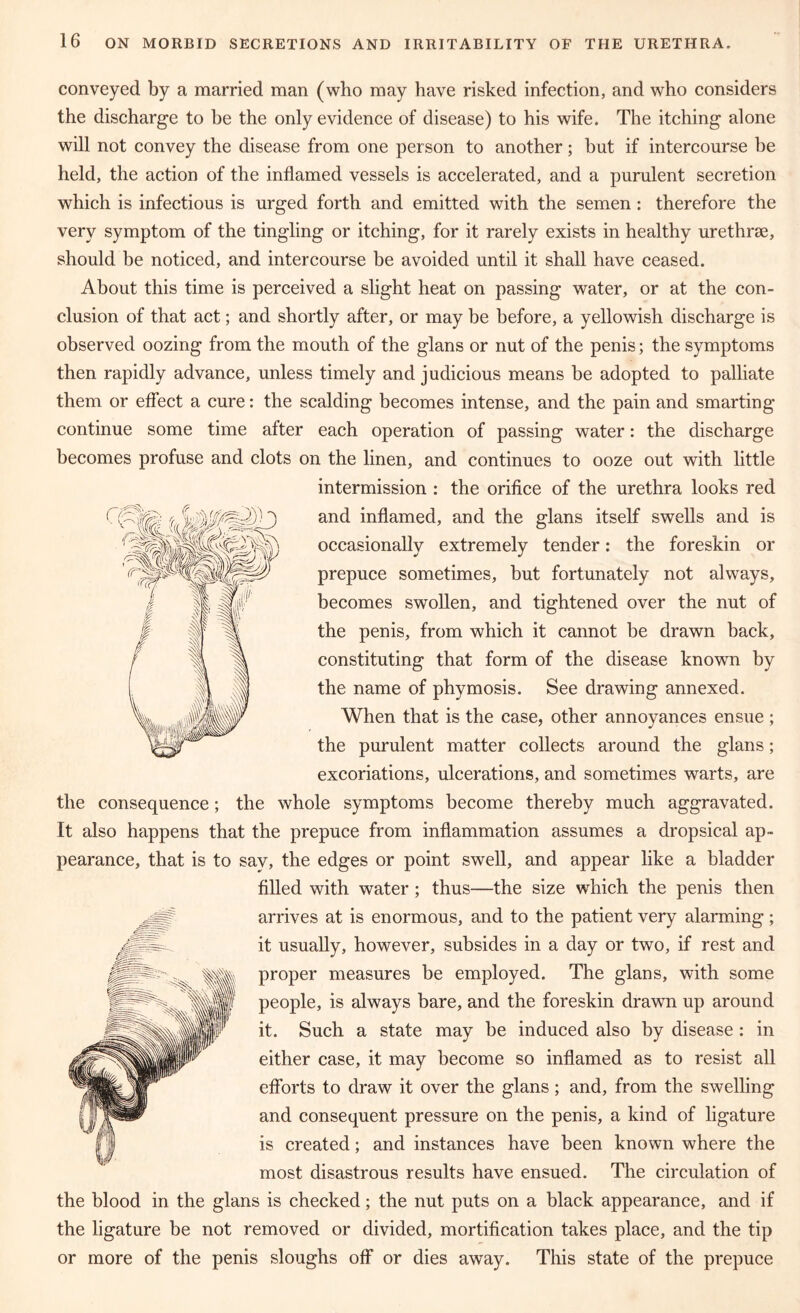 conveyed by a married man (who may have risked infection, and who considers the discharge to be the only evidence of disease) to his wife. The itching alone will not convey the disease from one person to another; but if intercourse be held, the action of the inflamed vessels is accelerated, and a purulent secretion which is infectious is urged forth and emitted with the semen : therefore the very symptom of the tingling or itching, for it rarely exists in healthy urethra, should be noticed, and intercourse be avoided until it shall have ceased. About this time is perceived a slight heat on passing water, or at the con- clusion of that act; and shortly after, or may be before, a yellowish discharge is observed oozing from the mouth of the glans or nut of the penis; the symptoms then rapidly advance, unless timely and judicious means be adopted to palliate them or effect a cure: the scalding becomes intense, and the pain and smarting continue some time after each operation of passing water: the discharge becomes profuse and clots on the linen, and continues to ooze out with little intermission : the orifice of the urethra looks red and inflamed, and the glans itself swells and is occasionally extremely tender: the foreskin or prepuce sometimes, but fortunately not always, becomes swollen, and tightened over the nut of the penis, from which it cannot be drawn back, constituting that form of the disease known by the name of phymosis. See drawing annexed. When that is the case, other annoyances ensue ; the purulent matter collects around the glans; excoriations, ulcerations, and sometimes warts, are the consequence; the whole symptoms become thereby much aggravated. It also happens that the prepuce from inflammation assumes a dropsical ap- pearance, that is to sav, the edges or point swell, and appear like a bladder filled with water; thus—the size which the penis then arrives at is enormous, and to the patient very alarming; it usually, however, subsides in a day or two, if rest and proper measures be employed. The glans, with some people, is always bare, and the foreskin drawn up around it. Such a state may be induced also by disease : in either case, it may become so inflamed as to resist all efforts to draw it over the glans; and, from the swelling and consequent pressure on the penis, a kind of ligature is created; and instances have been known where the most disastrous results have ensued. The circulation of the blood in the glans is checked; the nut puts on a black appearance, and if the ligature be not removed or divided, mortification takes place, and the tip or more of the penis sloughs off or dies away. This state of the prepuce
