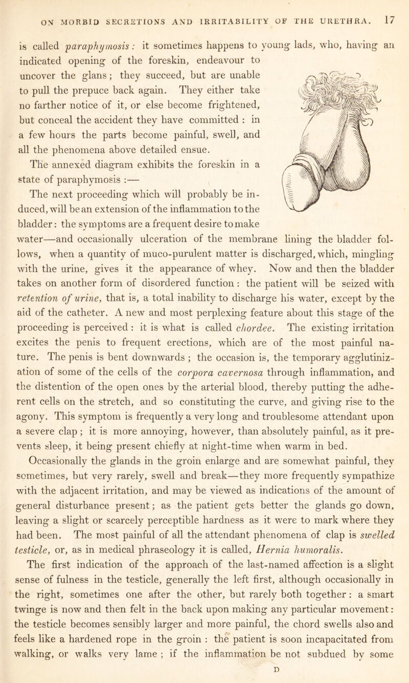 is called paraphimosis: it sometimes happens to young lads, who, having an indicated opening of the foreskin, endeavour to uncover the glans; they succeed, but are unable to pull the prepuce back again. They either take no farther notice of it, or else become frightened, but conceal the accident they have committed : in a few hours the parts become painful, swell, and all the phenomena above detailed ensue. The annexed diagram exhibits the foreskin in a state of paraphymosis :— The next proceeding which will probably be in- duced, will bean extension of the inflammation to the bladder: the symptoms are a frequent desire to make water—and occasionally ulceration of the membrane lining the bladder fol- lows, when a quantity of muco-purulent matter is discharged, which, mingling with the urine, gives it the appearance of whey. Now and then the bladder takes on another form of disordered function: the patient will be seized with retention of urine, that is, a total inability to discharge his water, except by the aid of the catheter. A new and most perplexing feature about this stage of the proceeding is perceived : it is what is called chordee. The existing irritation excites the penis to frequent erections, which are of the most painful na- ture. The penis is bent downwards ; the occasion is, the temporary agglutiniz- ation of some of the cells of the corpora cavernosa through inflammation, and the distention of the open ones by the arterial blood, thereby putting the adhe- rent cells on the stretch, and so constituting the curve, and giving rise to the agony. This symptom is frequently a very long and troublesome attendant upon a severe clap; it is more annoying, however, than absolutely painful, as it pre- vents sleep, it being present chiefly at night-time when warm in bed. Occasionally the glands in the groin enlarge and are somewhat painful, they sometimes, but very rarely, swell and break—they more frequently sympathize with the adjacent irritation, and may be viewed as indications of the amount of general disturbance present; as the patient gets better the glands go down, leaving a slight or scarcely perceptible hardness as it were to mark where they had been. The most painful of all the attendant phenomena of clap is swelled testicle, or, as in medical phraseology it is called. Hernia humor alls. The first indication of the approach of the last-named affection is a slight sense of fulness in the testicle, generally the left first, although occasionally in the right, sometimes one after the other, but rarely both together: a smart twinge is now and then felt in the back upon making any particular movement: the testicle becomes sensibly larger and more painful, the chord swells also and feels like a hardened rope in the groin : the patient is soon incapacitated from walking, or walks very lame ; if the inflammation be not subdued by some