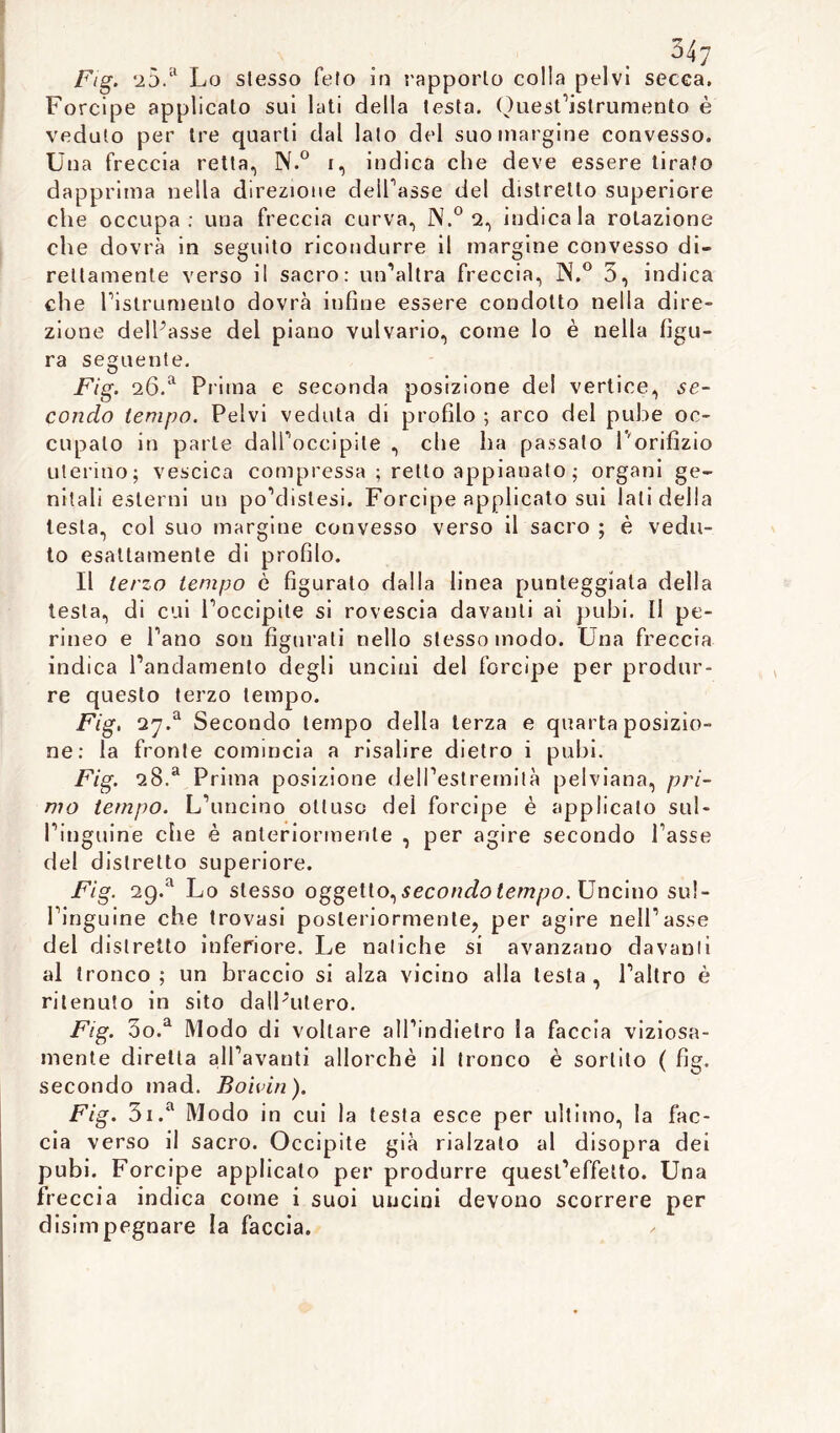 Forcipe applicato sui lati della testa, Quest’istrumento è vedalo per tre quarti dal lato del suo margine convesso. Una freccia retta, N.° r, indica che deve essere tirato dapprima nella direzione delibasse del distretto superiore che occupa: una freccia curva, N.° 2, indicala rotazione che dovrà in seguito ricondurre il margine convesso di- rettamente verso il sacro: un'altra freccia, N.° 3, indica che ristrumento dovrà infine essere condotto nella dire- zione delibasse del piano vulvario, come lo è nella figu- ra seguente, Fig. 26,a Prima e seconda posizione del vertice, se- condo tempo. Pelvi veduta di profilo ; arco del pube oc- cupalo in parte dalPoccipile , che ha passato l'orifizio uterino; vescica compressa ; retto appianato ; organi ge- nitali esterni un po’dislesi. Forcipe applicato sui lati della testa, col suo margine convesso verso il sacro ; è vedu- to esattamente di profilo. Il terzo tempo è figurato dalla linea punteggiala della testa, di cui roccipite si rovescia davanti ai pubi. Il pe- rineo e Pano son figurati nello stesso modo. Una freccia indica l’andamento degli uncini del forcipe per produr- re questo terzo tempo. Fig. 27.a Secondo tempo della terza e quarta posizio- ne: la fronte comincia a risalire dietro i pubi. Fig. 28.a Prima posizione dell’estremità pelviana, pri- mo tempo. L’uncino ottuso del forcipe è applicato sul- l’inguine che è anteriormente , per agire secondo l’asse del distretto superiore. Fig. 29.a Lo stesso oggetto, secondo tempo. Uncino sul- l’inguine che trovasi posteriormente, per agire nell’asse del distretto inferiore. Le natiche si avanzano davanti al tronco ; un braccio si alza vicino alla lesta , l’altro è ritenuto in sito dall'utero. Fig. 5o.a Modo di voltare all’indielro la faccia viziosa- mente diretta all’avanti allorché il tronco è sortito ( fig. secondo mad. Boivin ). Fig. 3i.a Modo in cui la testa esce per ultimo, la fac- cia verso il sacro. Occipite già rialzato al disopra dei pubi. Forcipe applicalo per produrre quest’effetto. Una freccia indica come i suoi uncini devono scorrere per disimpegnare la faccia.