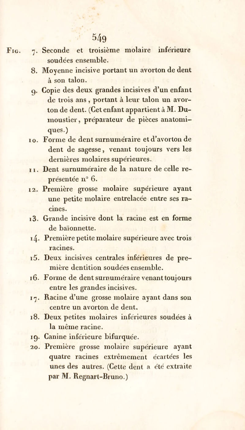 Fig. r]. Seconde et troisième molaire inférieure soudées ensemble. 8. Moyenne incisive portant un avorton de dent à son talon. 9. Copie des deux grandes incisives d’un enfant de trois ans , portant à leur talon un avor¬ ton de dent. (Cet enfant appartient à M. Du- moustier, préparateur de pièces anatomi¬ ques.) 10. Forme de dent surnuméraire et d’avorton de dent de sagesse, venant toujours vers les dernières molaires supérieures. 11. Dent surnuméraire de la nature de celle re¬ présentée 11° 6. 12. Première grosse molaire supérieure ayant une petite molaire entrelacée entre ses ra¬ cines. 13. Grande incisive dont la racine est en forme de baïonnette. 14- Première petite molaire supérieure avec trois racines. 15. Deux incisives centrales inférieures de pre¬ mière dentition soudées ensemble. 16. Forme de dent surnuméraire venant toujours entre les grandes incisives. 17. Racine d’une grosse molaire ayant dans sou centre un avorton de dent. 18. Deux petites molaires inférieures soudées à la même racine. 19. Canine inférieure bifurquée. 20. Première grosse molaire supérieure ayant quatre racines extrêmement écartées les unes des autres. (Cette dent a été extraite par M. Regnarl-Bruno.)