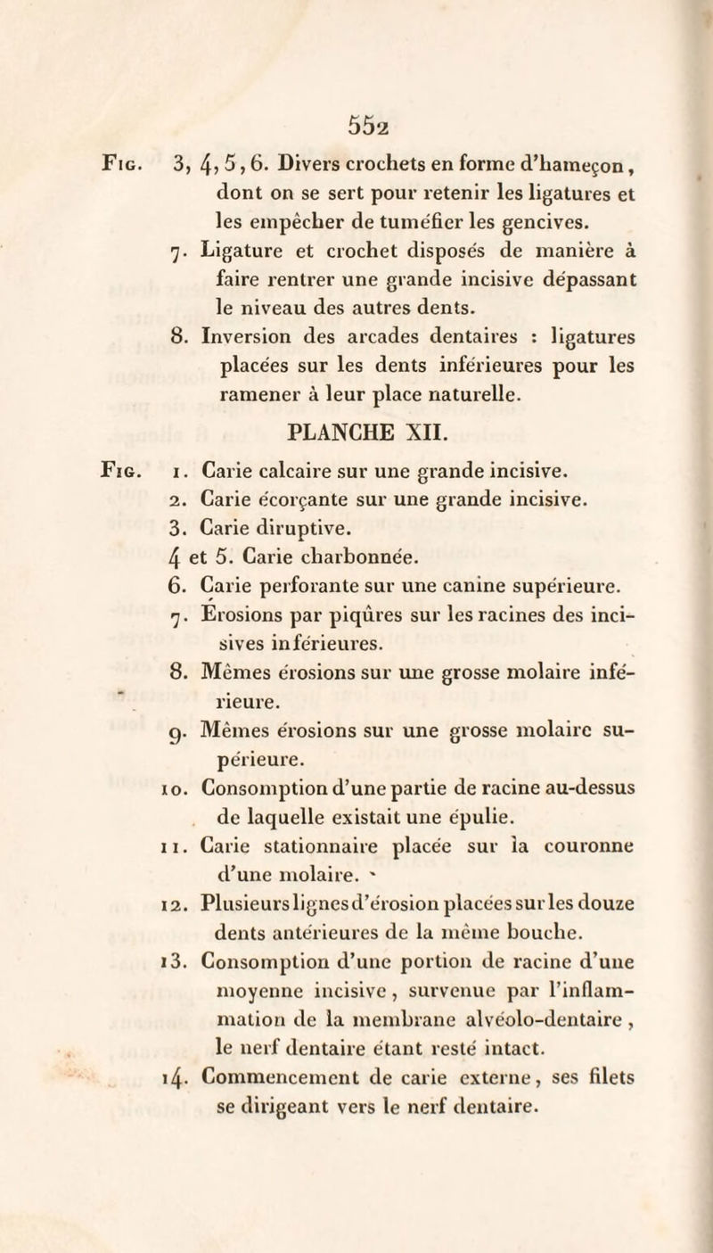 Fig. 3, 4> 5,6. Divers crochets en forme d’hameçon, dont on se sert pour retenir les ligatures et les empêcher de tuméfier les gencives. 7. Ligature et crochet disposés de manière à faire rentrer une grande incisive dépassant le niveau des autres dents. 8. Inversion des arcades dentaires : ligatures placées sur les dents inférieures pour les ramener à leur place naturelle. PLANCHE XII. Fig. i. Carie calcaire sur une grande incisive. 2. Carie e'corçante sur une grande incisive. 3. Carie diruptive. 4 et 5. Carie cliarbonnée. 6. Carie perforante sur une canine supérieure. 7. Erosions par piqûres sur les racines des inci¬ sives inférieures. 8. Mêmes érosions sur une grosse molaire infé¬ rieure. ç). Mêmes érosions sur une grosse molaire su¬ périeure. 10. Consomption d’une partie de racine au-dessus de laquelle existait une épulie. 11. Carie stationnaire placée sur la couronne d’une molaire. ' 12. Plusieurslignesd’érosionplacéessurlesdouze dents antérieures de la même bouche. 13. Consomption d’une portion de racine d’une moyenne incisive, survenue par l’inflam¬ mation de la membrane alvéolo-dentaire , le nerf dentaire étant resté intact. 14. Commencement de carie externe, ses filets se dirigeant vers le nerf dentaire.