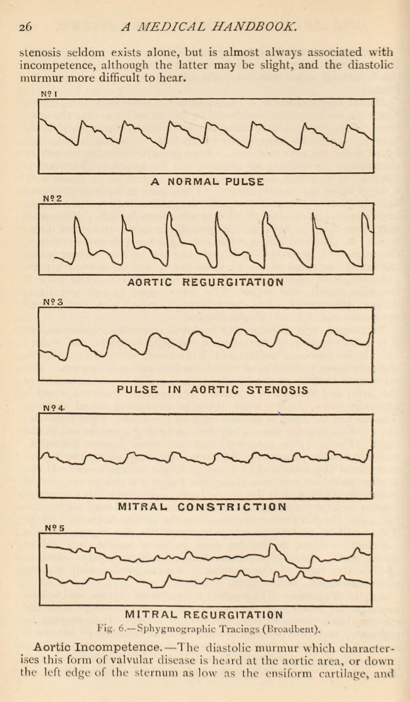 stenosis seldom exists alone, but is almost always associated with incompetence, although the latter may be slight, and the diastolic murmur more difficult to hear. AORTIC REGURGITATION N? 3 N94- N9 5 l''ig- 6.—Sphygmographic Tracings (liroadbent). Aortic Incompetence.—The diastolic murmur which character¬ ises this form of valvular disease is heard at the aortic area, or down the left edge of the sternum as low as the ensiform cartilage, and