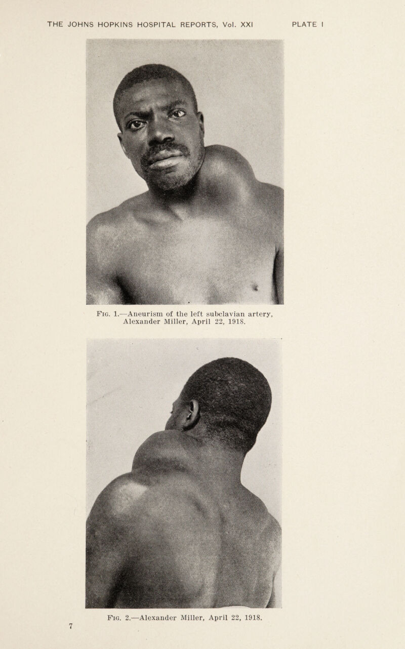 Fig. 1.-—Aneurism of the left subclavian artery, Alexander Miller, April 22, 1918. Fig. 2.—Alexander Miller, April 22, 1918