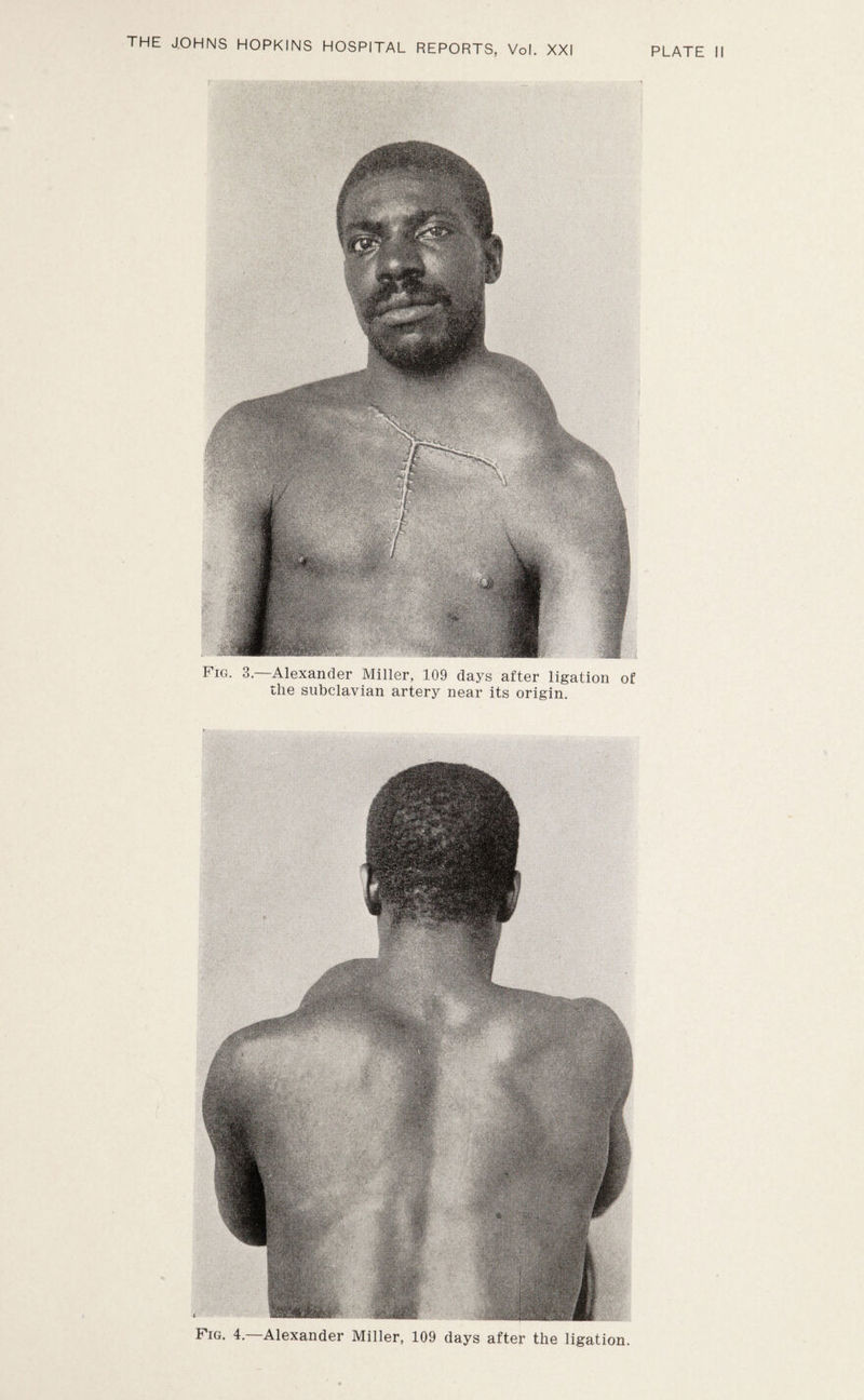 Fig. 3.—Alexander Miller, 109 days after ligation of the subclavian artery near its origin. Fig. 4. Alexander Miller, 109 days after the ligation.