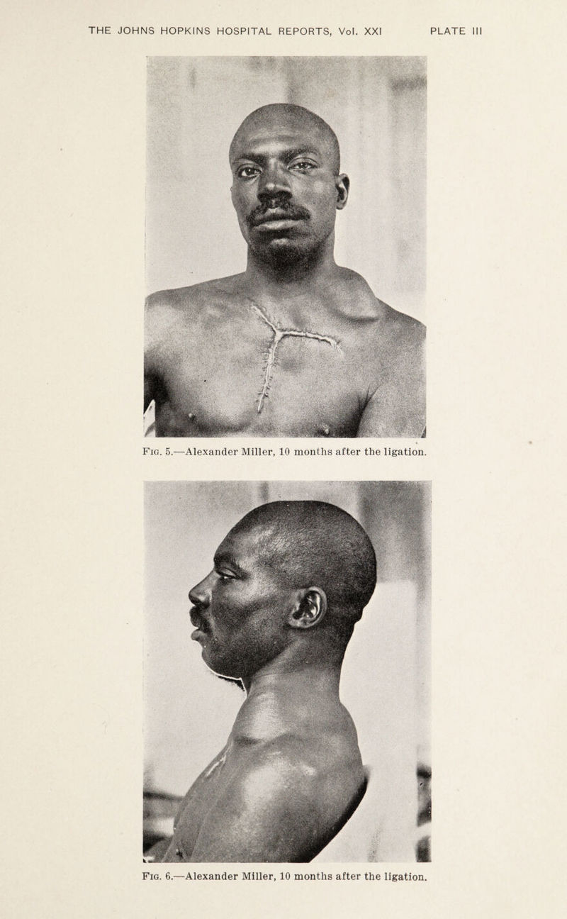 Fig. 5.—Alexander Miller, 10 months after the ligation.