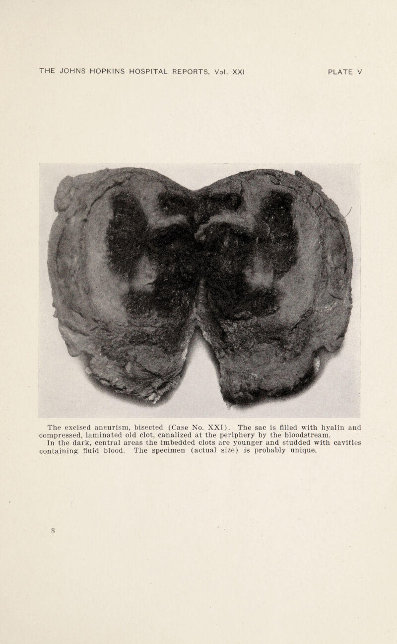The excised aneurism, bisected (Case No. XXI). The sac is filled with hyalin and compressed, laminated old clot, canalized at the periphery by the bloodstream. In the dark, central areas the imbedded clots are younger and studded with cavities containing fluid blood. The specimen (actual size) is probably unique.