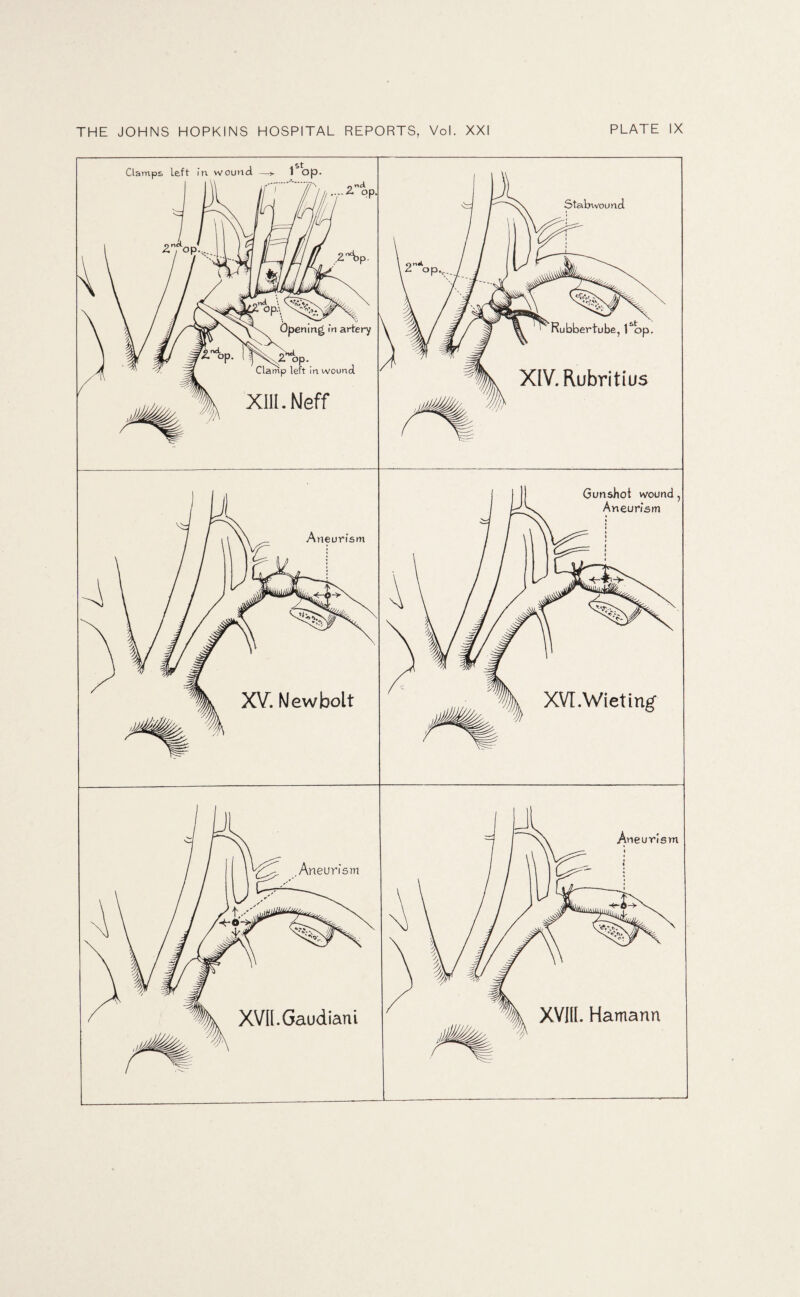 Clamps left in wound Stabwou nd ening m artery op- mp left in wound. XIII. Neff ubbertube, 1*op. Rubritius neurtsm Gunshot wound, Aneurism XV. New bolt XVr.Wieting* .Aneurism neunsm XVIl.Gaudiani XVIII. Hamann