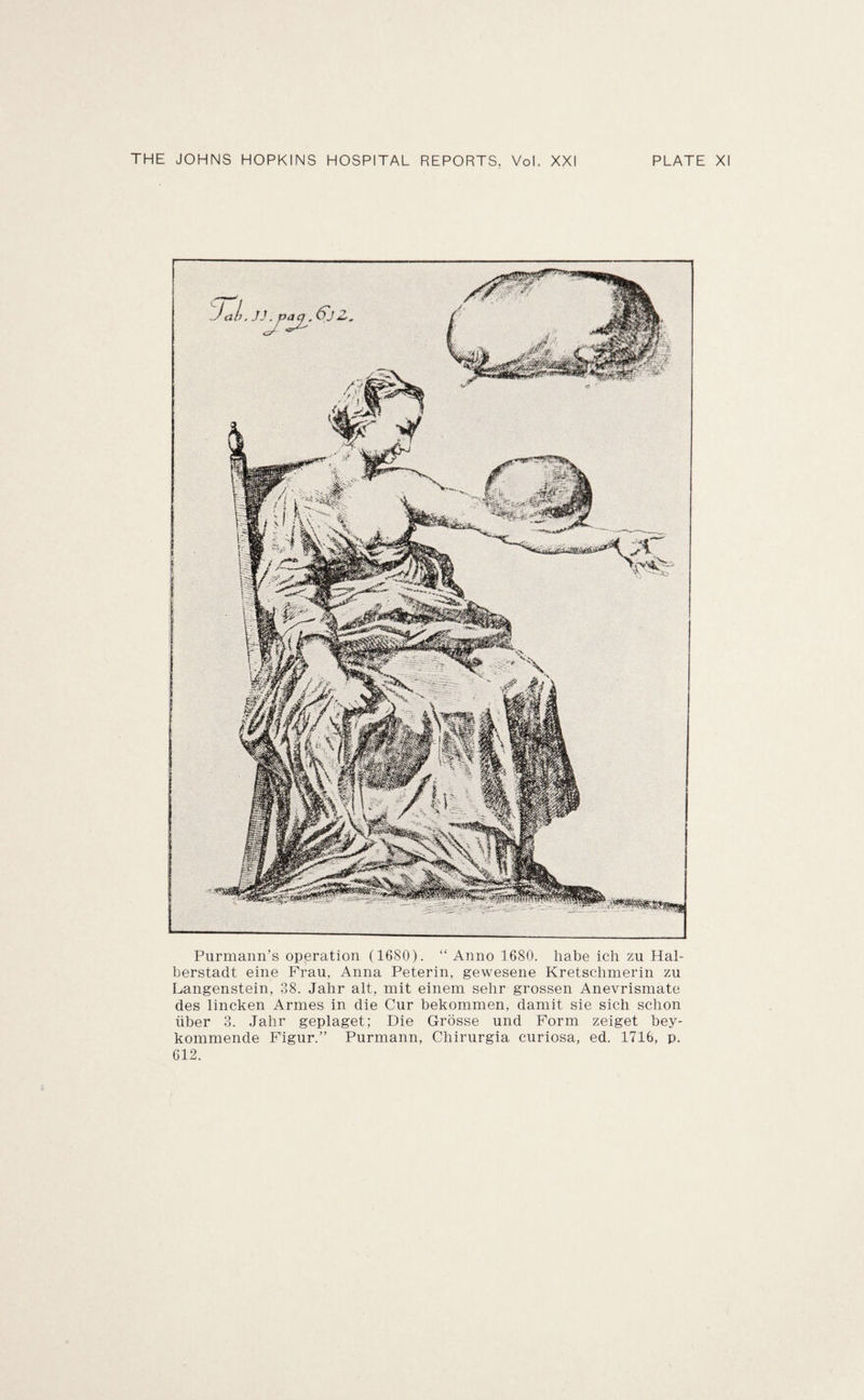 Purmann’s operation (1680). “ Anno 1680. habe ich zu Hal- berstadt eine Frau, Anna Peterin, gewesene Kretschmerin zu Langenstein, 38. Jahr alt, mit einem selir grossen Anevrismate des lincken Armes in die Cur bekommen, damit sie sich sclion iiber 3. Jahr geplaget; Die Grdsse und Form zeiget bey- kommende Figur.” Purmann, Chirurgia curiosa, ed. 1716, p. 612.