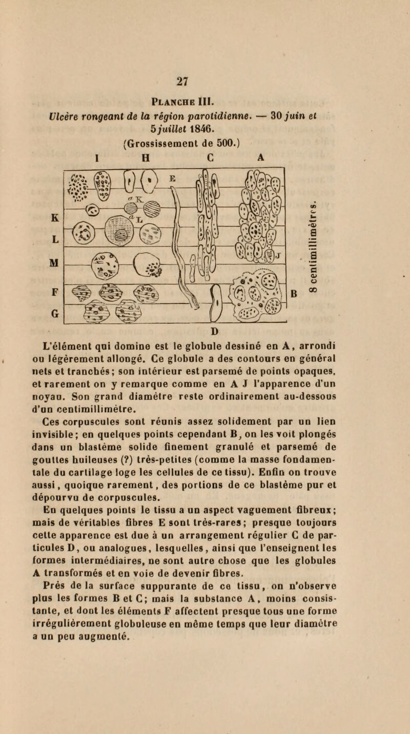 Planche III. Ulcère rongeant de la région parotidienne. — 30 juin et 5 juillet 1846. (Grossissement de 500.) I H CA L'élément qni domine est le globule dessiné en A, arrondi ou légèrement allongé. Ce globule a des contours en général nets et tranchés ; son intérieur est parsemé de points opaques, et rarement on y remarque comme en A J l'apparence d'un noyau. Son grand diamètre reste ordinairement au-dessous d’un centimillimèlre. Ces corpuscules sont réunis assez solidement par un lien invisible; en quelques points cependant B, on les voit plongés dans un blastème solide Gnement granulé et parsemé de gouttes huileuses (?) très-petites (comme la masse fondamen¬ tale du cartilage loge les cellules de ce tissu). Enün on trouve aussi, quoique rarement, des portions de ce blastème pur et dépourvu de corpuscules. En quelques points le tissu a un aspect vaguement Gbrenx; mais de véritables Gbres E sont très-rares ; presque toujours celte apparence est due à un arrangement régulier C de par¬ ticules D, ou analogues, lesquelles, ainsi que l’enseignent les formes intermédiaires, ne sont autre chose que les globules A transformés et en voie de devenir Gbres. Prés delà surface suppurante de ce tissu, on n’observe plus les formes BetC; mais la substance A, moins consis¬ tante, et dont les éléments F affectent presque tous une forme irrégulièrement globuleuse en même temps que leur diamètre a un peu augmenté.