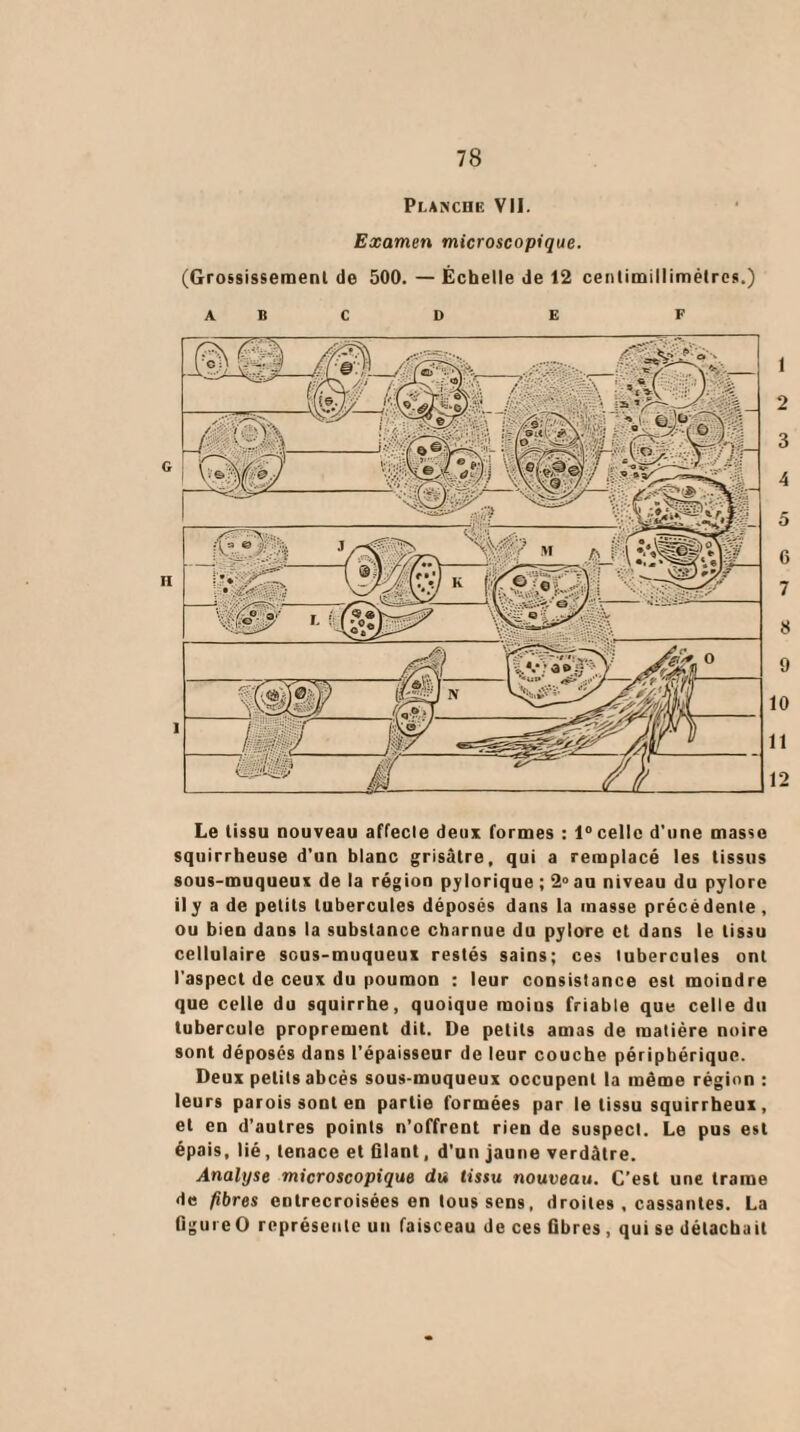 Planche VII. Examen microscopique. (Grossissement de 500. — Échelle de 12 cenlimillimètres.) a b c D E F Le lissu nouveau affecle deux formes : 1°celle d’une masse squirrheuse d’un blanc grisâtre, qui a remplacé les tissus sous-muqueux de la région pylorique ; 2° au niveau du pylore ily a de petits tubercules déposés dans la masse précédente , ou bien dans la substance charnue du pylore et dans le lissu cellulaire scus-muqueux restés sains; ces tubercules ont l'aspect de ceux du poumon : leur consistance est moindre que celle du squirrhe, quoique moius friable que celle du tubercule proprement dit. De petits amas de matière noire sont déposés dans l’épaisseur de leur couche périphérique. Deux petits abcès sous-muqueux occupent la même région : leurs parois sont en partie formées par le tissu squirrheux, et en d’autres points n’offrent rien de suspect. Le pus est épais, lié, tenace et filant, d’un jaune verdâtre. Analyse microscopique du tissu nouveau. C’est une trame de fibres entrecroisées en tous sens, droites , cassantes. La figureO représente un faisceau de ces fibres , qui se détachait 1 2 3 4 5 6 7 8 9 10 11 12