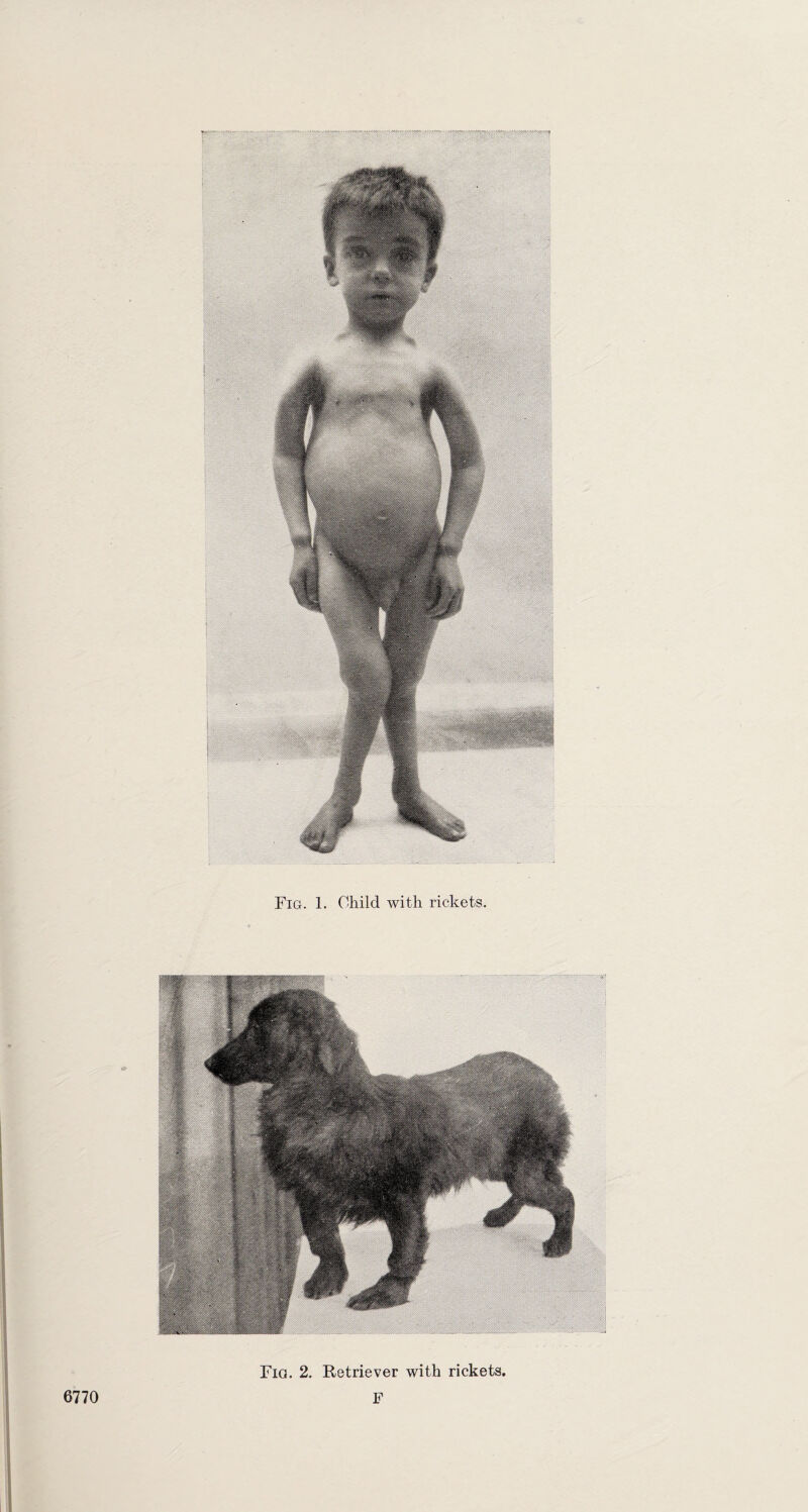 Fig. 1. Child with rickets. ■■ 6770 F