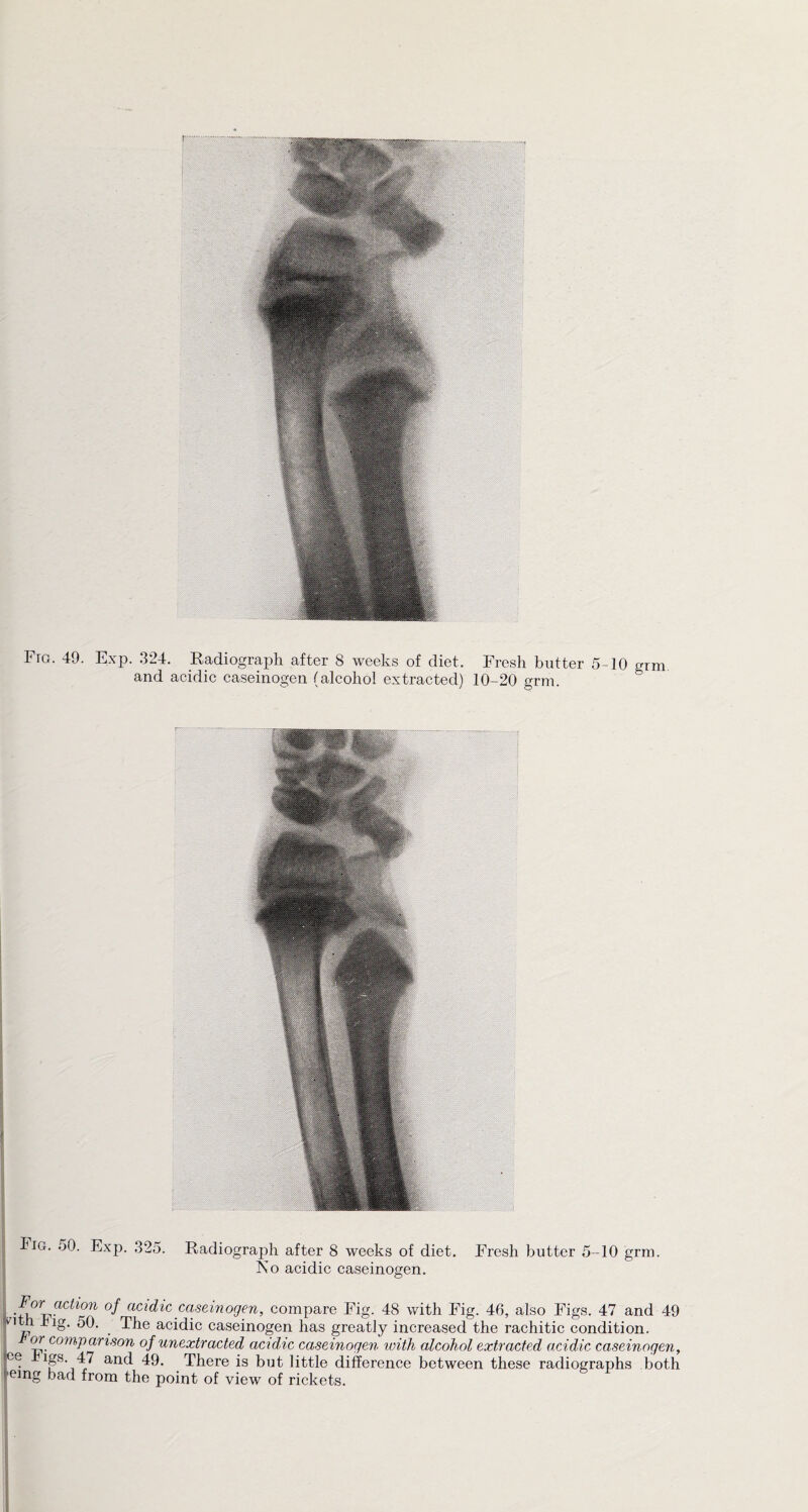 and acidic caseinogen (alcohol extracted) 10-20 grm. Fig. 50. Exp. .325. Radiograph after 8 weeks of diet. Fresh butter 5-10 grm. No acidic caseinogen. For action of acidic caseinogen, compare Fig. 48 with Fig. 46, also Figs. 47 and 49 vi h 4ig. 50. The acidic caseinogen has greatly increased the rachitic condition. or comparison of unextracted acidic caseinogen with alcohol extracted acidic caseinogen, °e igs. 47 and 49. There is but little difference between these radiographs both ’emg bad from the point of view of rickets.