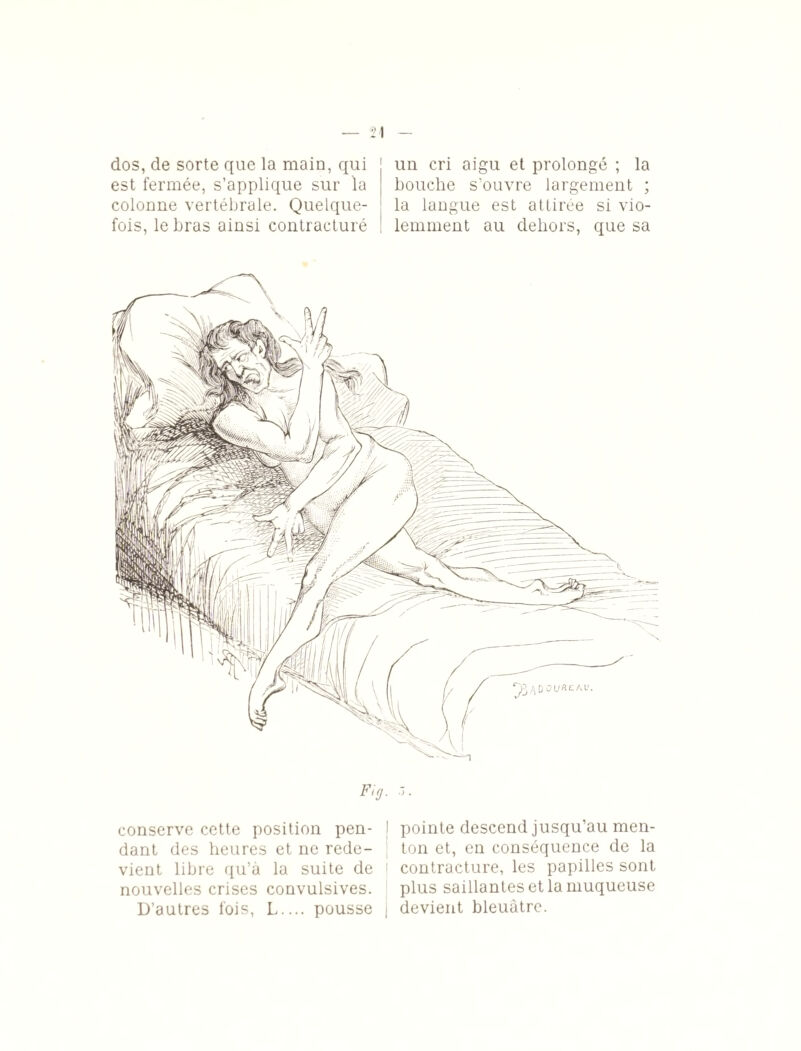 dos, de sorte que la main, qui est fermée, s’applique sur la colonne vertébrale. Quelque¬ fois, le bras ainsi contracturé un cri aigu et prolongé ; la bouche s’ouvre largement ; la langue est attirée si vio¬ lemment au dehors, que sa Fig. .t. conserve cette position pen- ! pointe descend jusqu’au men- dant des heures et ne rede- ton et, en conséquence de la vient libre qu’à la suite de contracture, les papilles sont nouvelles crises convulsives. plus saillantes et la muqueuse D’autres fois, L.... pousse j devient bleuâtre.