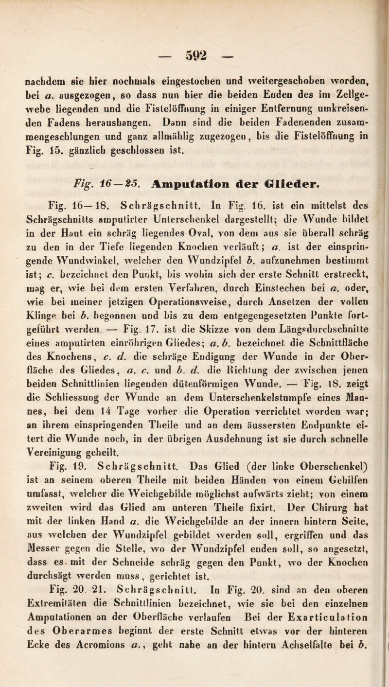 nachdem sie hier nochmals eingestochen und weitergeschoben worden, bei a. ausgezogen, so dass nun hier die beiden Enden des im Zellge- webe liegenden und die Fisleiöffnung in einiger Entfernung umkreisen- den Fadens herausbangen. Dann sind die beiden Fadenenden zusam- mengeschlungen und ganz ailmählig zugezogen, bis die Fistelöffnung in Fig. 15. gänzlich geschlossen ist. Fig. 16—25. Amputation der Crlieder. Fig. 16—18. Schrägschnitt. In Fig. 16. ist ein mittelst des Schrägschnitts amputirler Unterschenkel dargestellt; die Wunde bildet in der Haut ein schräg liegendes Oval, von den» aus sie überall schräg zu den in der Tiefe liegenden Knochen verläuft; a. ist der einsprin- gende Wundwinkel, welcher den Wundzipfel b. aufzunehmen bestimmt ist; c. bezeichnet den Punkt, bis wohin sich der erste Schnitt erstreckt, mag er, wie bei dem ersten Verfahren, durch Einstechen bei a. oder, wie bei meiner jetzigen Operationsweise, durch Ansetzen der vollen Klinge bei b. begonnen und bis zu dem entgegengesetzten Punkte fort- geführt werden. — Fig. 17. ist die Skizze von dem Längsdurehschnitte eines amputirten einröhrigen Gliedes; a.b. bezeichnet die Schnittfläche des Knochens, c. d. die schräge Endigung der Wunde in der Ober- fläche des Gliedes, a. c. und b. d. die Hiebtung der zwischen jenen beiden Schnittlinien liegenden dütenförmigen Wunde. — Fig. iS. zeigt die Schliessung der Wunde an dem Unterschenkelstumpfe eines Man- nes, bei dem 14 Tage vorher die Operation verrichtet worden war; an ihrem einspringenden Theile und an dem äussersten Endpunkte ei- tert die Wunde noch, in der übrigen Ausdehnung ist sie durch schnelle Vereinigung geheilt. Fig. 19. Schräg schnitt. Das Glied (der linke Oberschenkel) ist an seinem oberen Theile mit beiden Händen von einem Gehilfen umfasst, welcher die Weichgebilde möglichst aufwärts zieht; von einem zweiten wird das Glied am unteren Theile fixirt. Der Chirurg hat mit der linken Hand a. die Weichgebilde an der innern hintern Seite, aus welchen der Wundzipfel gebildet werden soll, ergriffen und das Messer gegen die Stelle, wo der Wundzipfel enden soll, so angesetzt, dass es. mit der Schneide schräg gegen den Punkt, wo der Knochen durchsägt werden muss, gerichtet ist. Fig. 20. 21. Schrägschnitt. In Fig. 20. sind an den oberen Extremitäten die Schnittlinien bezeichnet, wie sie bei den einzelnen Amputationen an der Oberfläche verlaufen Bei der Exarticulation des Oberarmes beginnt der erste Schnitt etwas vor der hinteren Ecke des Acromions a., geht nahe an der hintern Achselfalte bei b.