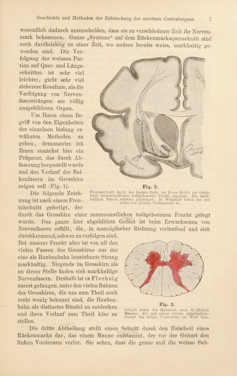 wesentlich dadurch unterscheiden, dass sie zu verschiedener Zeit ihr Nerven¬ mark bekommen. Ganze „Systeme“ auf dem Rückenmarksquerschnitt sind noch durchsichtig* zu einer Zeit, wo andere bereits weiss, markhaltig ge¬ worden sind. Die Ver¬ folgung der weissen Par¬ tien auf Quer- und Längs¬ schnitten ist sehr viel leichter, giebt sehr viel sicherere Resultate, als die Verfolgung von Nerven¬ fasersträngen am völlig ausgebildeten Organ. Um Ihnen einen Be¬ griff von den Eigenheiten der einzelnen bislang er¬ wähnten Methoden zu geben, demonstrire ich Ihnen zunächst hier ein Präparat, das durch Ab¬ faserung hergestellt wurde und den Verlauf der Bal¬ kenfasern im Grosshirn zeigen soll (Fig. 1). Die folgende Zeich¬ nung ist nach einem Fron¬ talschnitt gefertigt, der durch das Grosshirn einer neunmonatlichen todtgeborenen Frucht gelegt wurde. Das ganze hier abgebildete Gebiet ist beim Erwachsenen von Nervenfasern erfüllt, die, in mannigfacher Richtung verlaufend und sich durchkreuzend, schwer zu verfolgen sind. Bei unserer Frucht aber ist von all den vielen Fasern des Grosshirns nur der eine als Haubenbahn bezeichnete Strang markhaltig. Nirgends im Grosshirn als an dieser Stelle finden sich markhaltige Nervenfasern. Deshalb ist es Flechsig zuerst gelungen, unter den vielen Bahnen des Grosshirns, die uns zum Theil noch recht wenig bekannt sind, die Hauben¬ bahn als distinctes Bündel zu entdecken und ihren Verlauf zum Theil klar zu stellen. Die dritte Abtheilung stellt einen Schnitt durch den Halstheil eines Rückenmarks dar, das einem Manne entstammt, der vor der Geburt den linken Vorderarm verlor. Sie sehen, dass die graue und die weisse Sub- Fig. 2. Erontalschnitt durch, das hintere Ende der Fossa Sylvii am Gehirn einer neunmonatlichen todtgehorenen Eracht angelegt. Die mark¬ haltigen Easern schwarz gezeichnet. In Wahrheit liehen sie sich weiss von grauem Untergründe ah. Fig. 3. Schnitt durch das Halsmark eines 45 jährigen Mannes, der mit einem kurzen Amputations¬ stumpf des linken Vorderarms zur Welt kam.