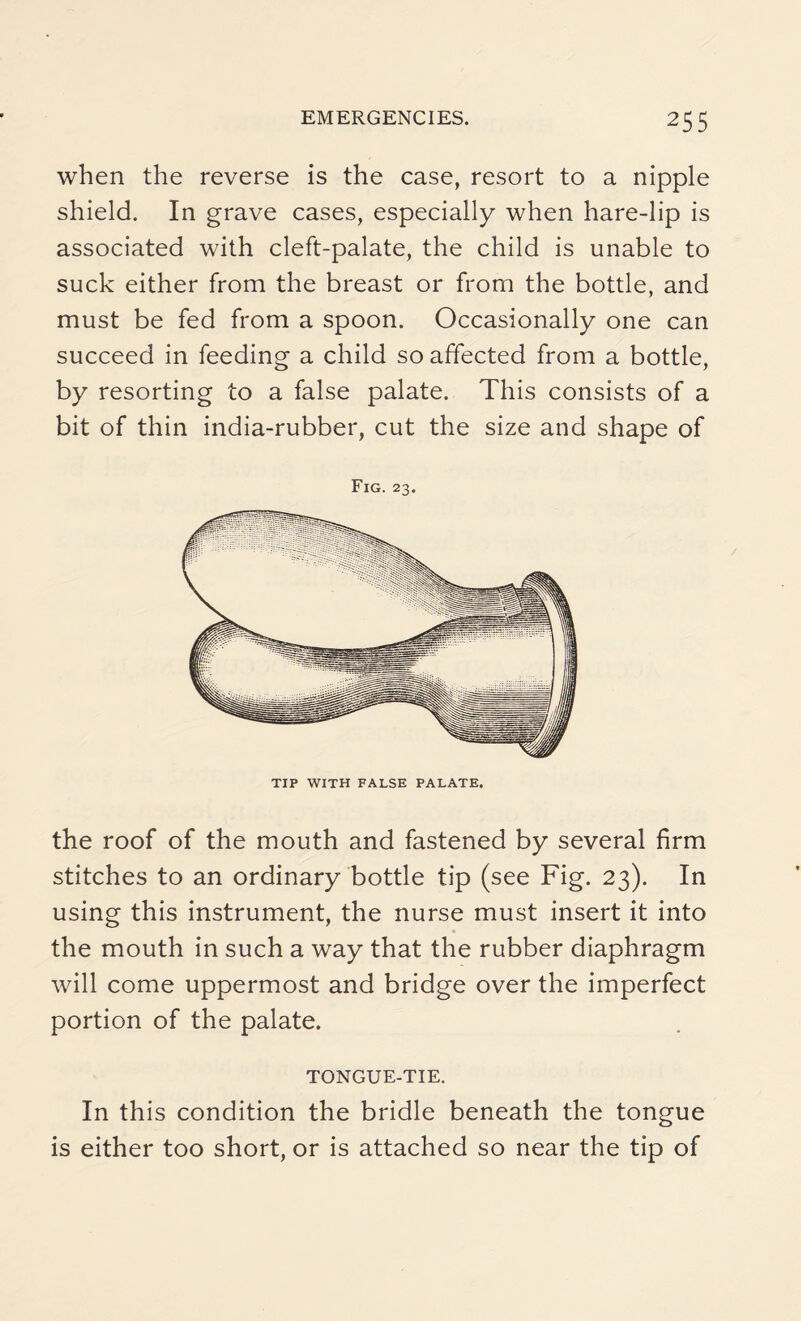 when the reverse is the case, resort to a nipple shield. In grave cases, especially when hare-lip is associated with cleft-palate, the child is unable to suck either from the breast or from the bottle, and must be fed from a spoon. Occasionally one can succeed in feeding a child so affected from a bottle, by resorting to a false palate. This consists of a bit of thin india-rubber, cut the size and shape of Fig. 23. TIP WITH FALSE PALATE. the roof of the mouth and fastened by several firm stitches to an ordinary bottle tip (see Fig. 23). In using this instrument, the nurse must insert it into the mouth in such a way that the rubber diaphragm will come uppermost and bridge over the imperfect portion of the palate. TONGUE-TIE. In this condition the bridle beneath the tongue is either too short, or is attached so near the tip of