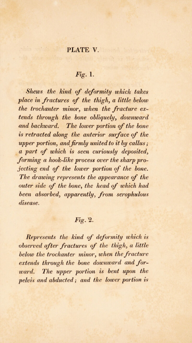 Fig, 1. Shews the kind of deformity which takes place in fractures of the thigh, a little below the trochanter minor, when the fracture ex- tends through the hone obliquely, downward and backward. The lower portion of the bone is retracted along the anterior surface of the upper portion, and firmly united to it by callus; a part of which is seen curiously deposited, forming a hook-like process over the sharp pro- jecting end of the lower portion of the hone. The drawing represents the appearance of the outer side of the hone, the head of which had been absorbed, apparently, from serophulous disease. Fig, Represents the kind of deformity which is observed after fractures of the thigh, a little below the trochanter minor, when the fracture extends through the bone downward and for- ward, The upper portion is bent upon the pelvis and abducted; and the lower portion is