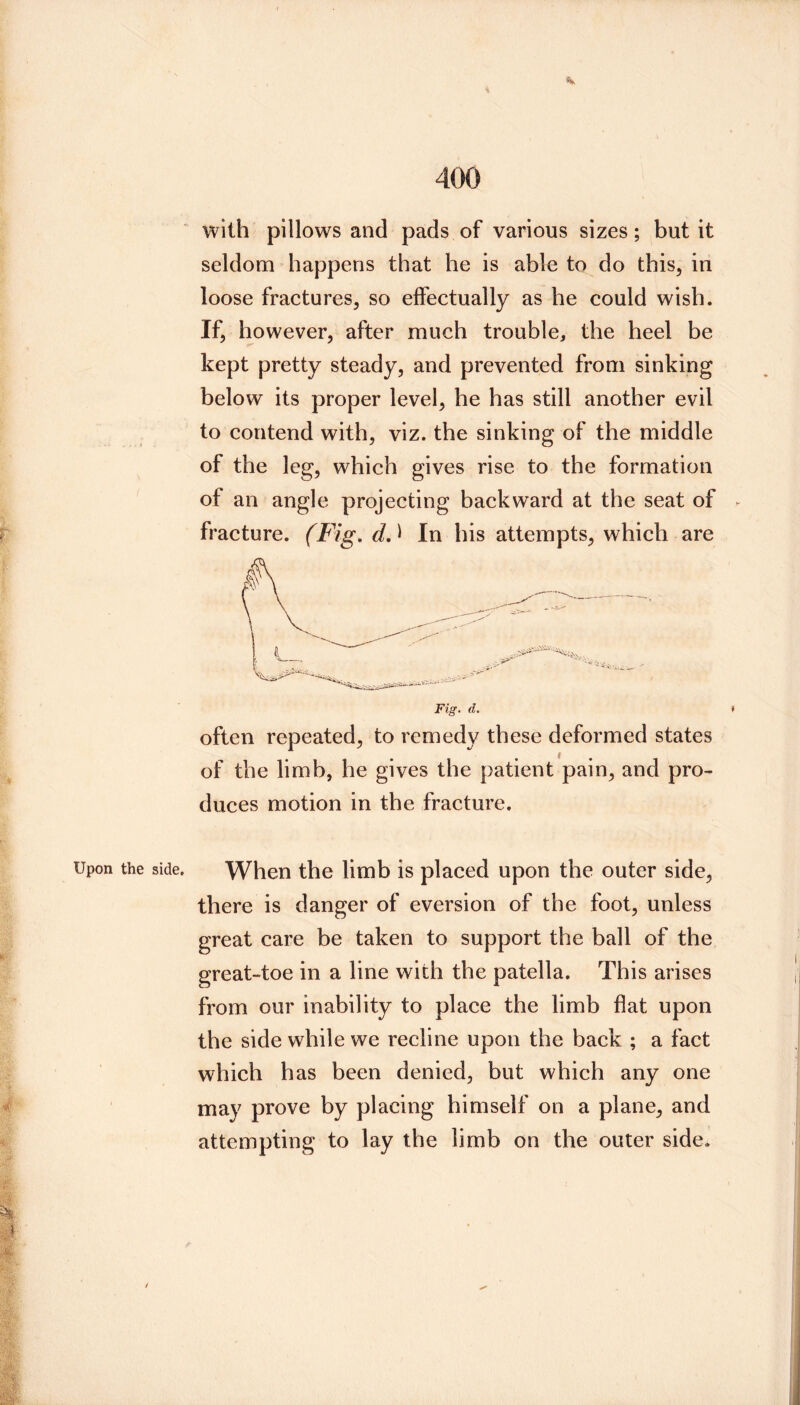 with pillows and pads of various sizes; but it seldom happens that he is able to do this, in loose fraetures, so effectually as he could wish. If, however, after much trouble, the heel be kept pretty steady, and prevented from sinking below its proper level, he has still another evil to contend with, viz. the sinking of the middle of the leg, which gives rise to the formation of an angle projecting backward at the seat of fracture. (Fig. In his attempts, which are often repeated, to remedy these deformed states of the limb, he gives the patient pain, and pro- duces motion in the fracture. When the limb is placed upon the outer side, there is danger of eversion of the foot, unless great care be taken to support the ball of the great-toe in a line with the patella. This arises from our inability to place the limb flat upon the side while we recline upon the back ; a fact which has been denied, but which any one may prove by placing himself on a plane, and attempting to lay the limb on the outer side.