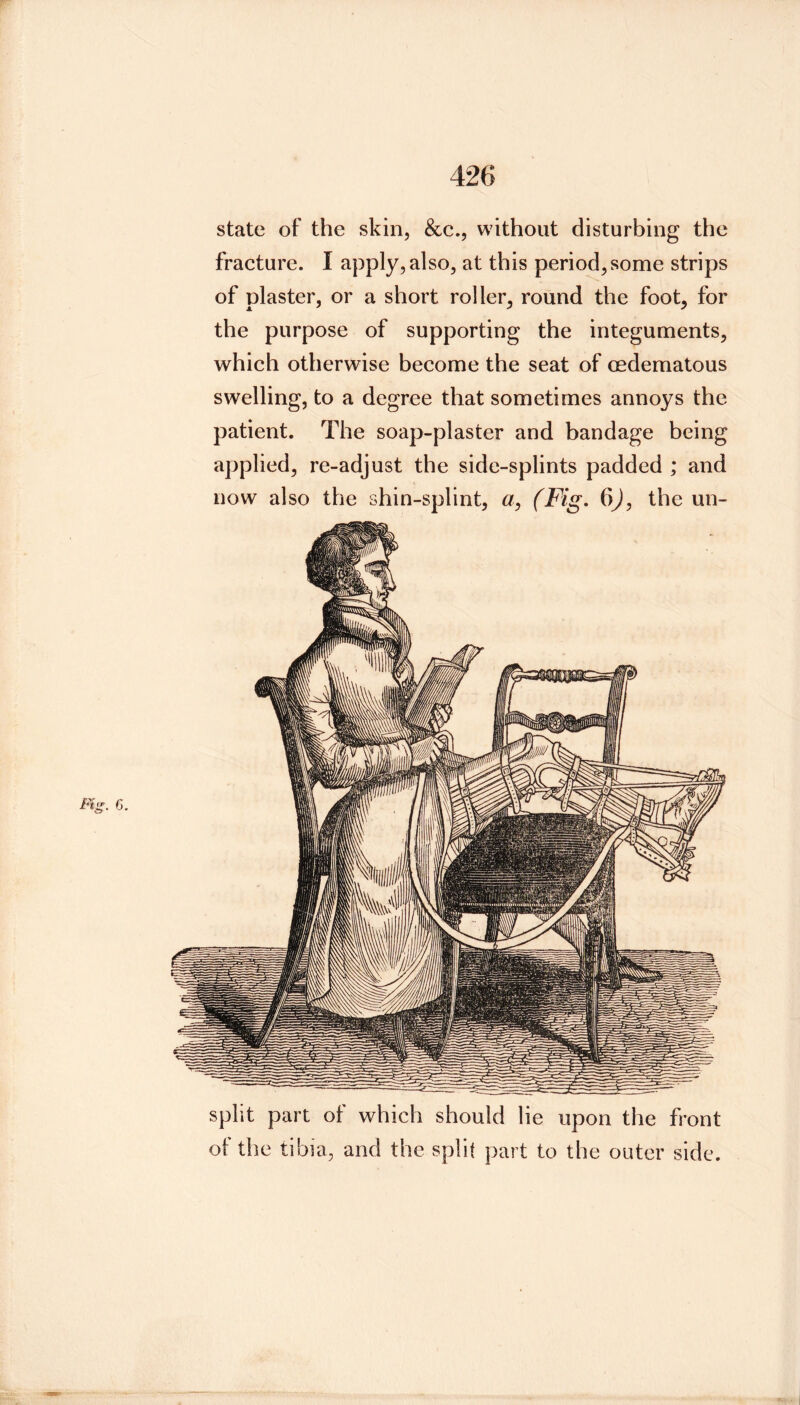 state of the skin, &c., without disturbing the fracture. I apply, also, at this period,some strips of plaster, or a short roller, round the foot, for the purpose of supporting the integuments, which otherwise become the seat of oedematous swelling, to a degree that sometimes annoys the patient. The soap-plaster and bandage being applied, re-adjust the side-splints padded ; and now also the shin-splint, ^7, (Fig. the un- split part of which should lie upon the front of the tibia, and the split part to the outer side.