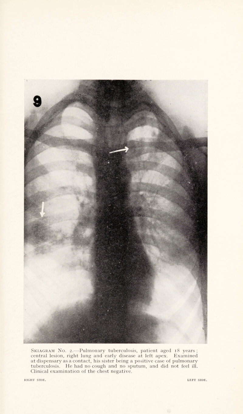 Skiagram No. 2.—Pulmonary tuberculosis, patient aged 18 years ; central lesion, right lung and early disease at left apex. Examined at dispensary as a contact, his sister being a positive case of pulmonary tuberculosis. He had no cough and no sputum, and did not feel ill. Clinical examination of the chest negative. 1