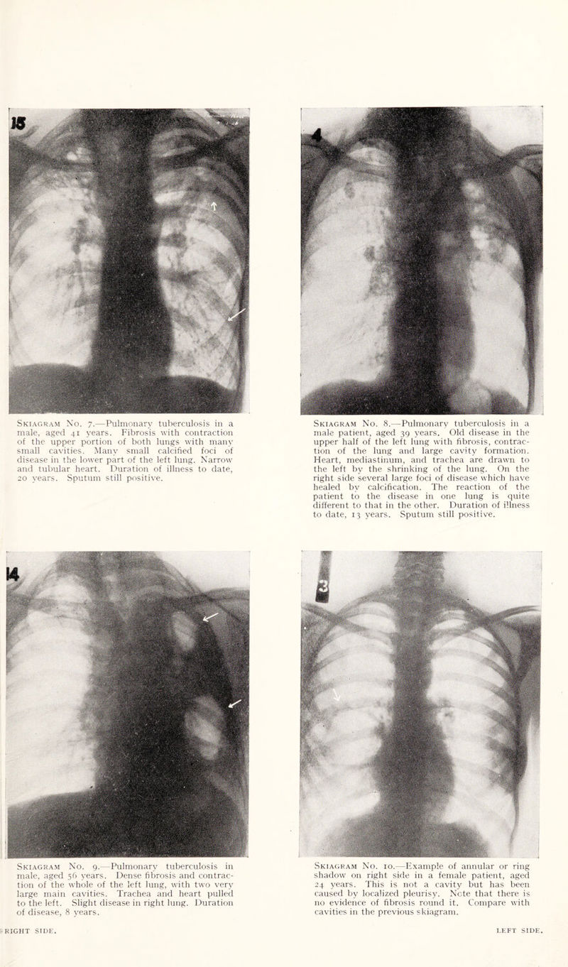 Skiagram No. 7.—Pulmonary tuberculosis in a male, aged 41 years. Fibrosis with contraction of the upper portion of both lungs with many small cavities. Many small calcified foci of disease in the lower part of the left lung. Narrow and tubular heart. Duration of illness to date, 20 years. Sputum still positive. Skiagram No. 8.—Pulmonary tuberculosis in a male patient, aged 39 years. Old disease in the upper half of the left lung with fibrosis, contrac¬ tion of the lung and large cavity formation. Heart, mediastinum, and trachea are drawn to the left by the shrinking of the lung. On the right side several large foci of disease which have healed by calcification. The reaction of the patient to the disease in one lung is quite different to that in the other. Duration of illness to date, 13 years. Sputum still positive. Skiagram No. 9.—Pulmonary tuberculosis in male, aged 56 years. Dense fibrosis and contrac¬ tion of the whole of the left lung, with two very large main cavities. Trachea and heart pulled to the left. Slight disease in right lung. Duration of disease, 8 years. Skiagram No. 10.—Example of annular or ring shadow on right side in a female patient, aged 24 years. This is not a cavity but has been caused by localized pleurisy. Note that there is no evidence of fibrosis round it. Compare with cavities in the previous skiagram.