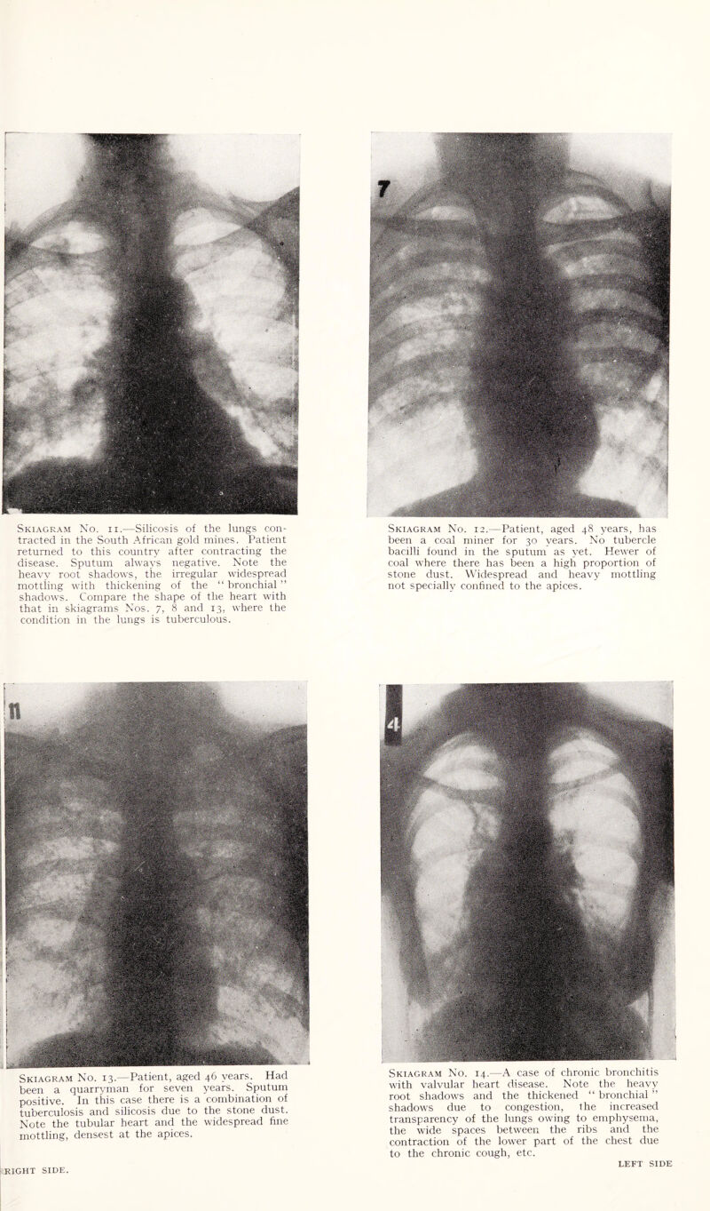 Skiagram No. ii.—Silicosis of the lungs con¬ tracted in the South African gold mines. Patient returned to this country after contracting the disease. Sputum always negative. Note the heavy root shadows, the irregular widespread mottling with thickening of the “bronchial” shadows. Compare the shape of the heart with that in skiagrams Nos. 7, 8 and 13, where the condition in the lungs is tuberculous. Skiagram No. 12.—Patient, aged 48 years, has been a coal miner for 30 years. No tubercle bacilli found in the sputum as yet. Hewer of coal where there has been a high proportion of stone dust. Widespread and heavy mottling not specially confined to the apices. Skiagram No. 13.—Patient, aged 46 years. Had been a quarryman for seven years. Sputum positive. In this case there is a combination of tuberculosis and silicosis due to the stone dust. Note the tubular heart and the widespread fine mottling, densest at the apices. Skiagram No. 14.—A case of chronic bronchitis with valvular heart disease. Note the heavy root shadows and the thickened “ bronchial ” shadows due to congestion, the increased transparency of the lungs owing to emphysema, the wide spaces between the ribs and the contraction of the lower part of the chest due to the chronic cough, etc.