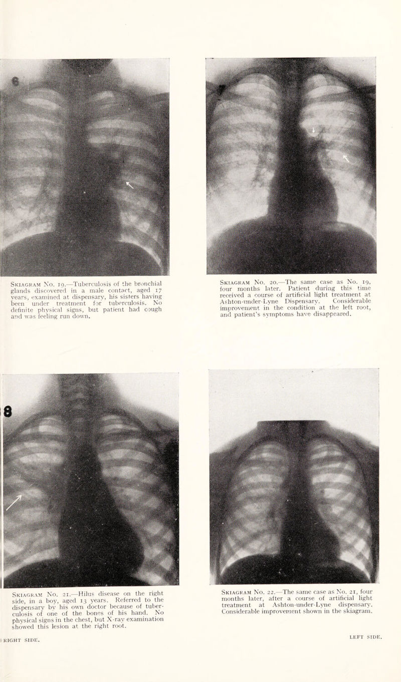 Skiagram No. 19.—Tuberculosis of the bronchial glands discovered in a male contact, aged 17 years, examined at dispensary, his sisters having been under treatment for tuberculosis. No definite physical signs, but patient had cough and was feeling run down. Skiagram No. 21.—Hilus disease on the right side, in a boy, aged 13 years. Referred to the dispensary bv his own doctor because of tuber¬ culosis of one of the bones of his hand. No physical signs in the chest, but X-ray examination showed this lesion at the right root. Skiagram No. 20.—The same case as No. 19, four months later. Patient during this time received a course of artificial light treatment at Ashton-under-Lyne Dispensary. Considerable improvement in the condition at the left root, and patient’s symptoms have disappeared. Skiagram No. 22.—The same case as No. 21, four months later, after a course of artificial light treatment at Ashton-under-Lyne dispensary. Considerable improvement shown in the skiagram.