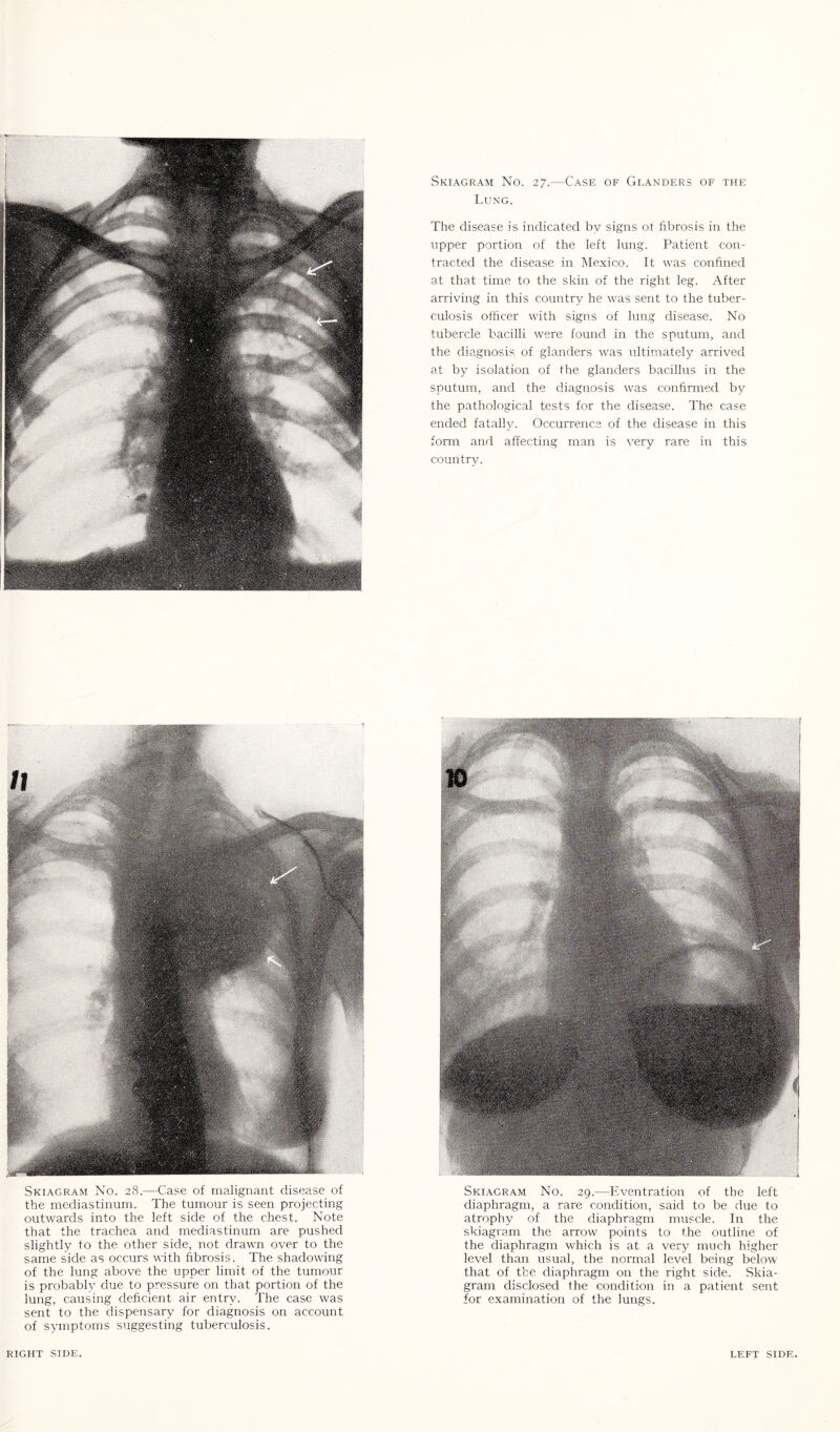 Lung. The disease is indicated by signs ol fibrosis in the upper portion of the left lung. Patient con¬ tracted the disease in Mexico. It was confined at that time to the skin of the right leg. After arriving in this country he was sent to the tuber¬ culosis officer with signs of lung disease. No tubercle bacilli were found in the sputum, and the diagnosis of glanders was ultimately arrived at by isolation of the glanders bacillus in the sputum, and the diagnosis was confirmed by the pathological tests for the disease. The case ended fatally. Occurrence of the disease in this form and affecting man is very rare in this country. Skiagram No. 28.—Case of malignant disease of the mediastinum. The tumour is seen projecting outwards into the left side of the chest. Note that the trachea and mediastinum are pushed slightly to the other side, not drawn over to the same side as occurs with fibrosis. The shadowing of the lung above the upper limit of the tumour is probably due to pressure on that portion of the lung, causing deficient air entry. The case was sent to the dispensary for diagnosis on account of symptoms suggesting tuberculosis. Skiagram No. 29.—Eventration of the left diaphragm, a rare condition, said to be due to atrophy of the diaphragm muscle. In the skiagram the arrow points to the outline of the diaphragm which is at a very much higher level than usual, the normal level being below that of the diaphragm on the right side. Skia¬ gram disclosed the condition in a patient sent for examination of the lungs.