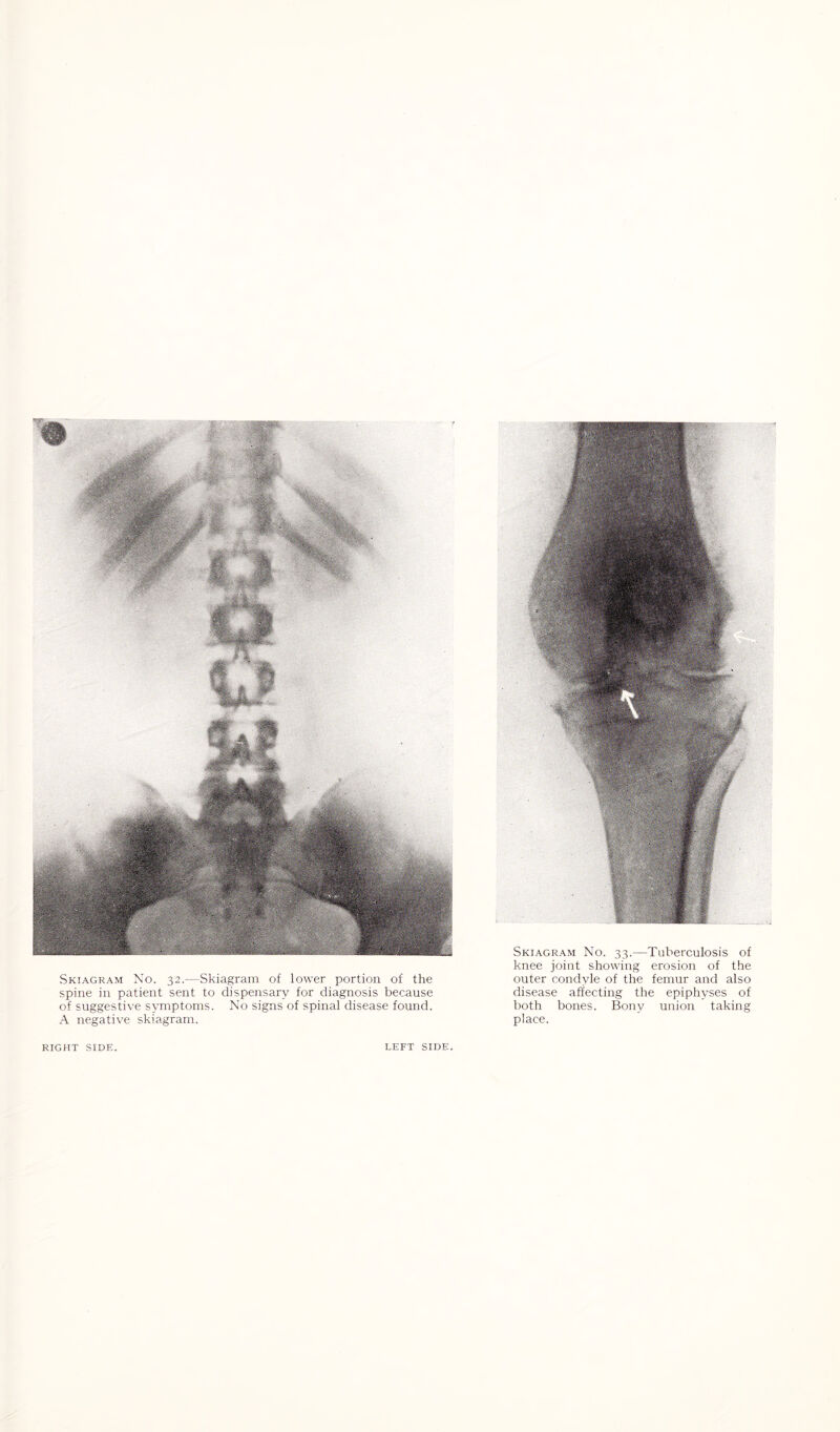 Skiagram No. 32.—Skiagram of lower portion of the spine in patient sent to dispensary for diagnosis because of suggestive symptoms. No signs of spinal disease found. A negative skiagram. Skiagram No. 33.—Tuberculosis of knee joint showing erosion of the outer condyle of the femur and also disease affecting the epiphyses of both bones. Bony union taking place.